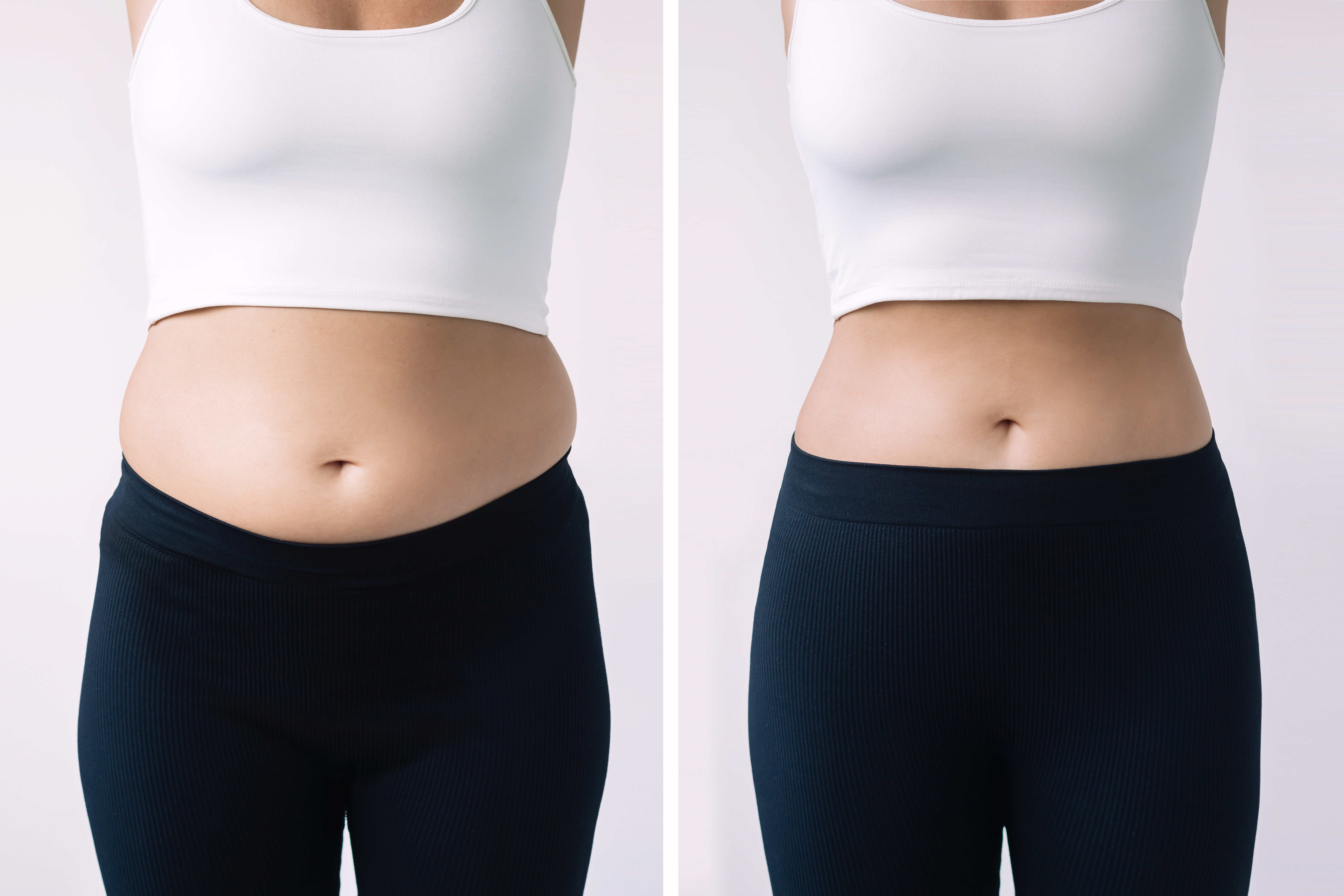 Liposuction in Turkey before and after 1