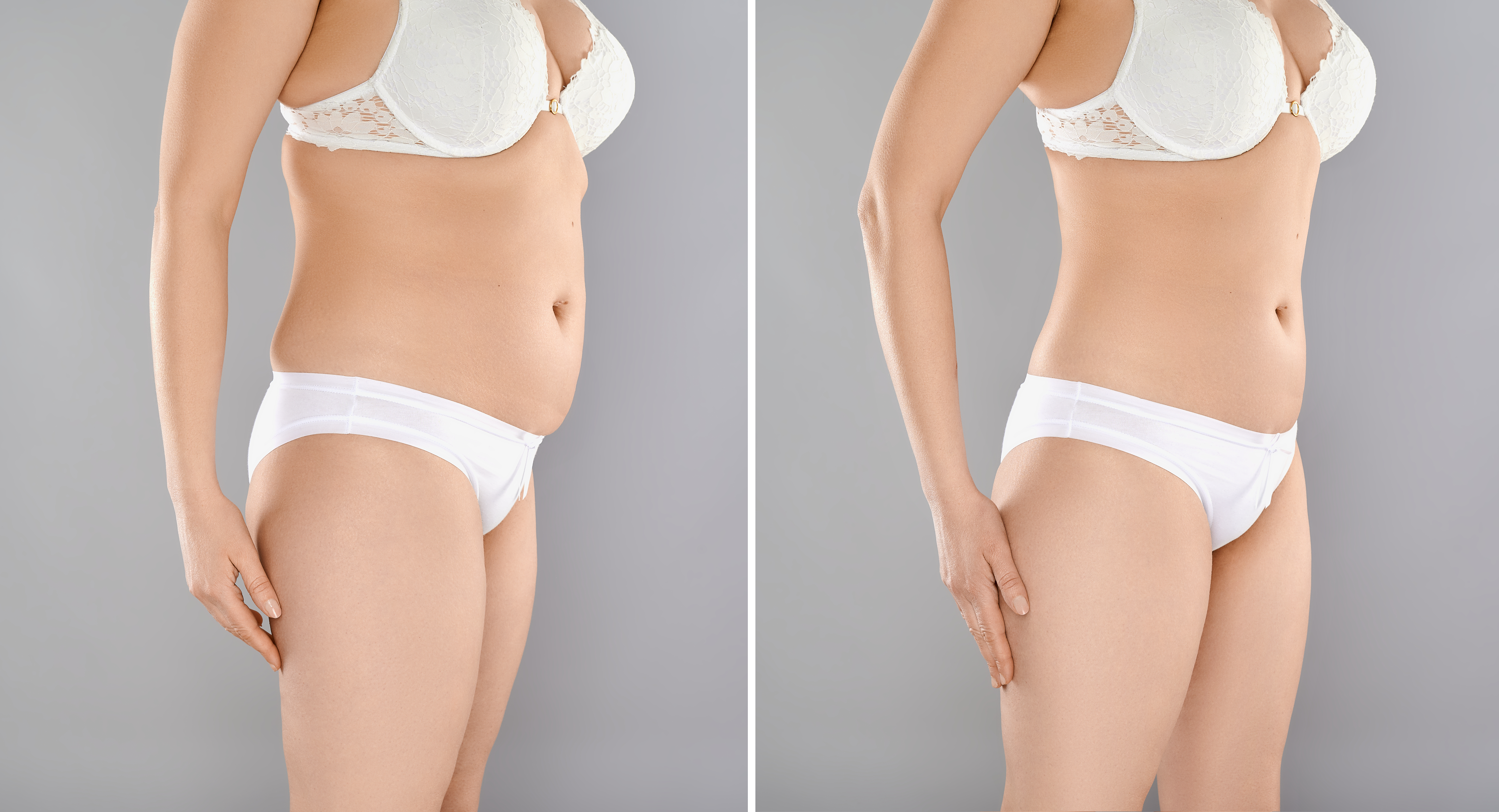Liposuction in Turkey before and after 3