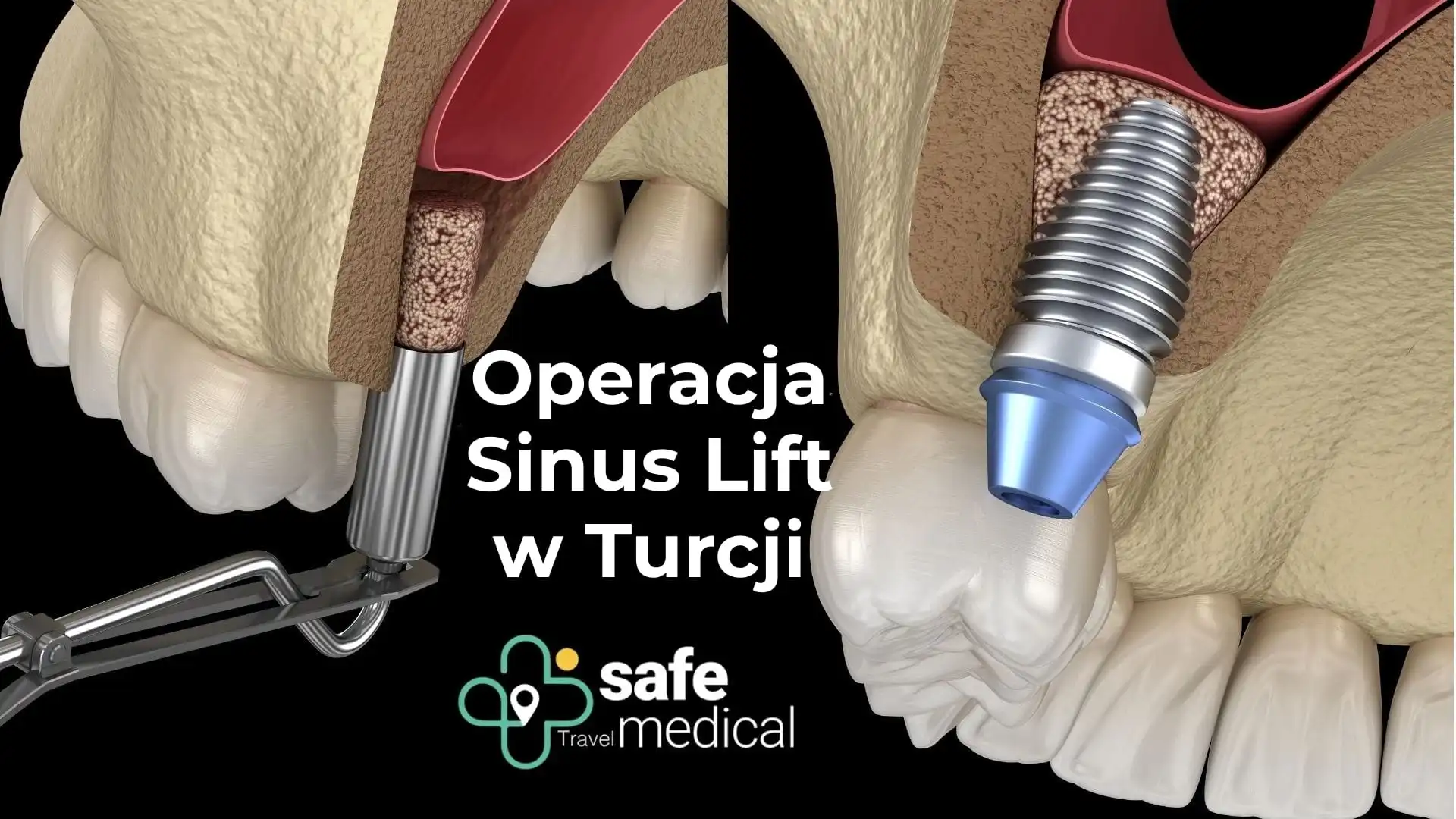 Operacja Sinus Lift w Turcji