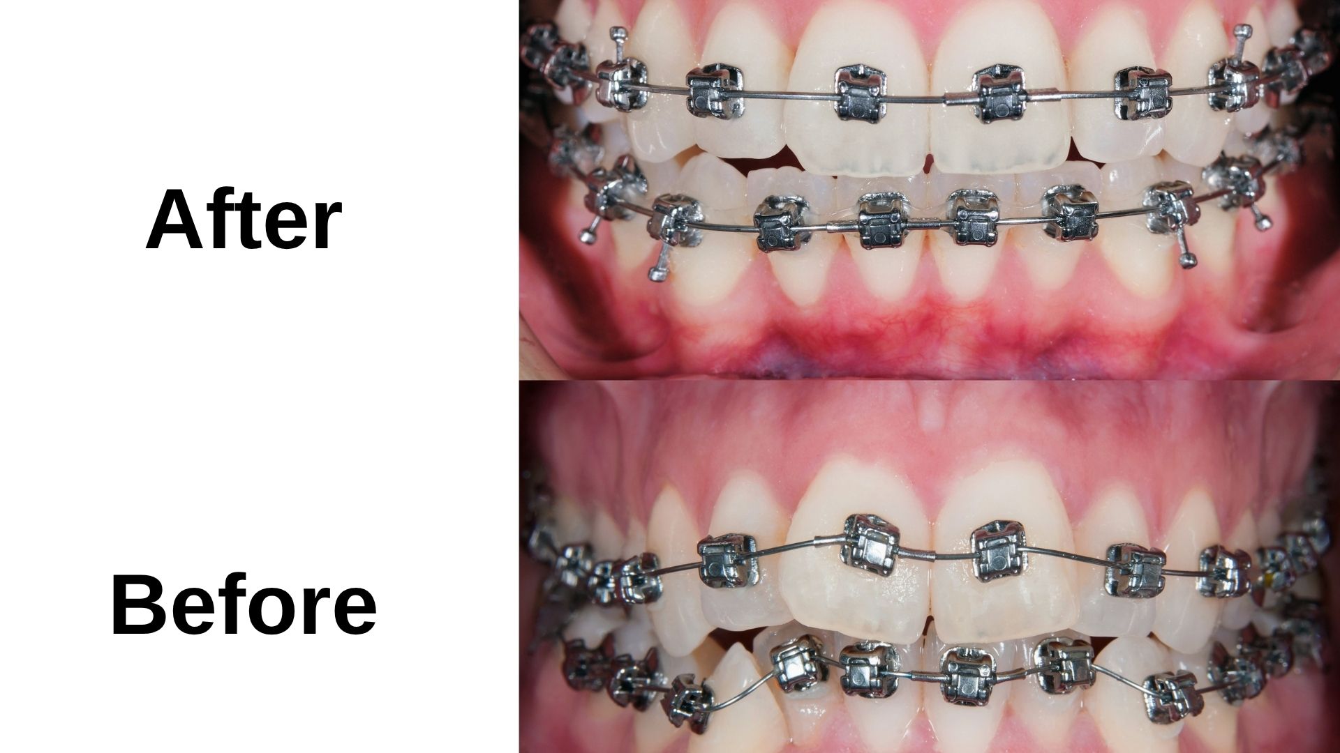Metal Brackets Metal Brackets