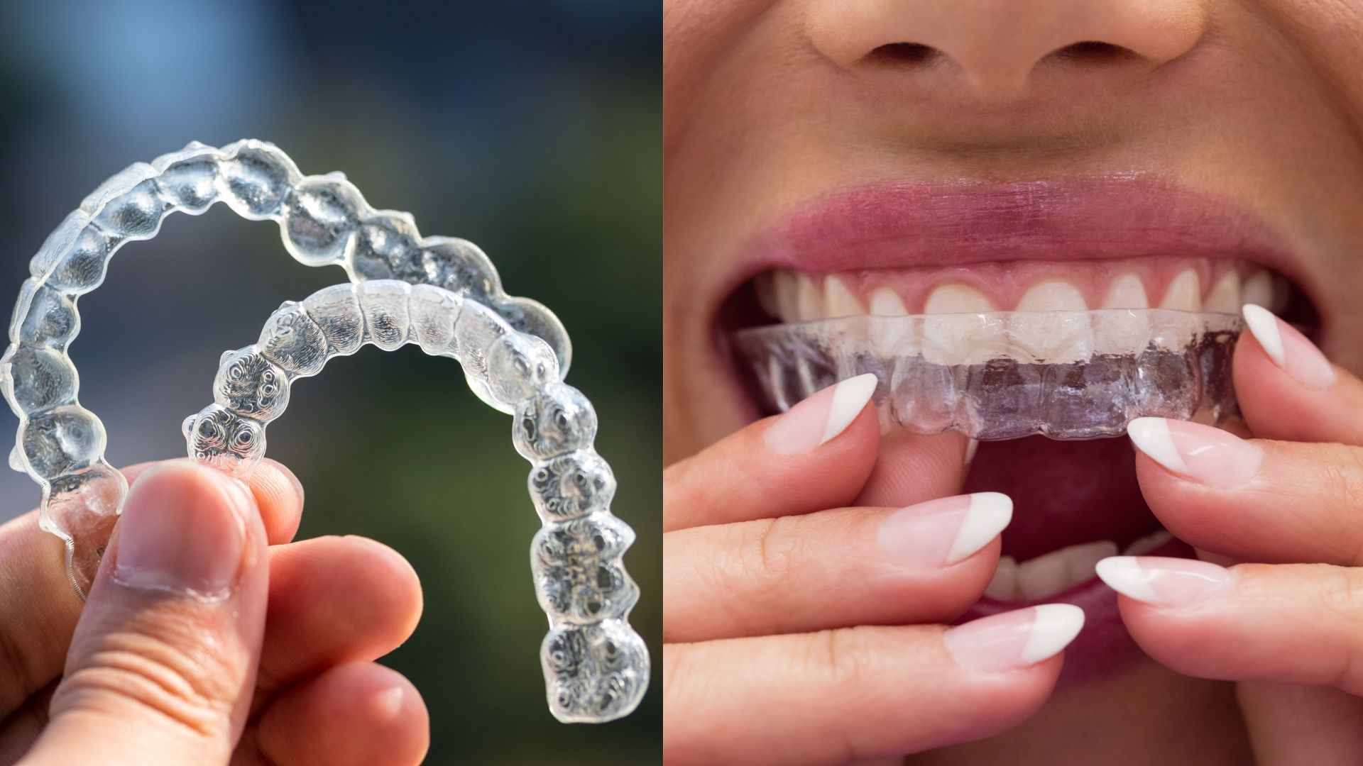 Clear aligners Clear aligners