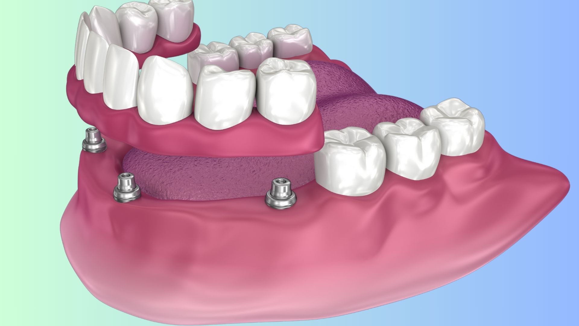 Implant-supported overdentures 
