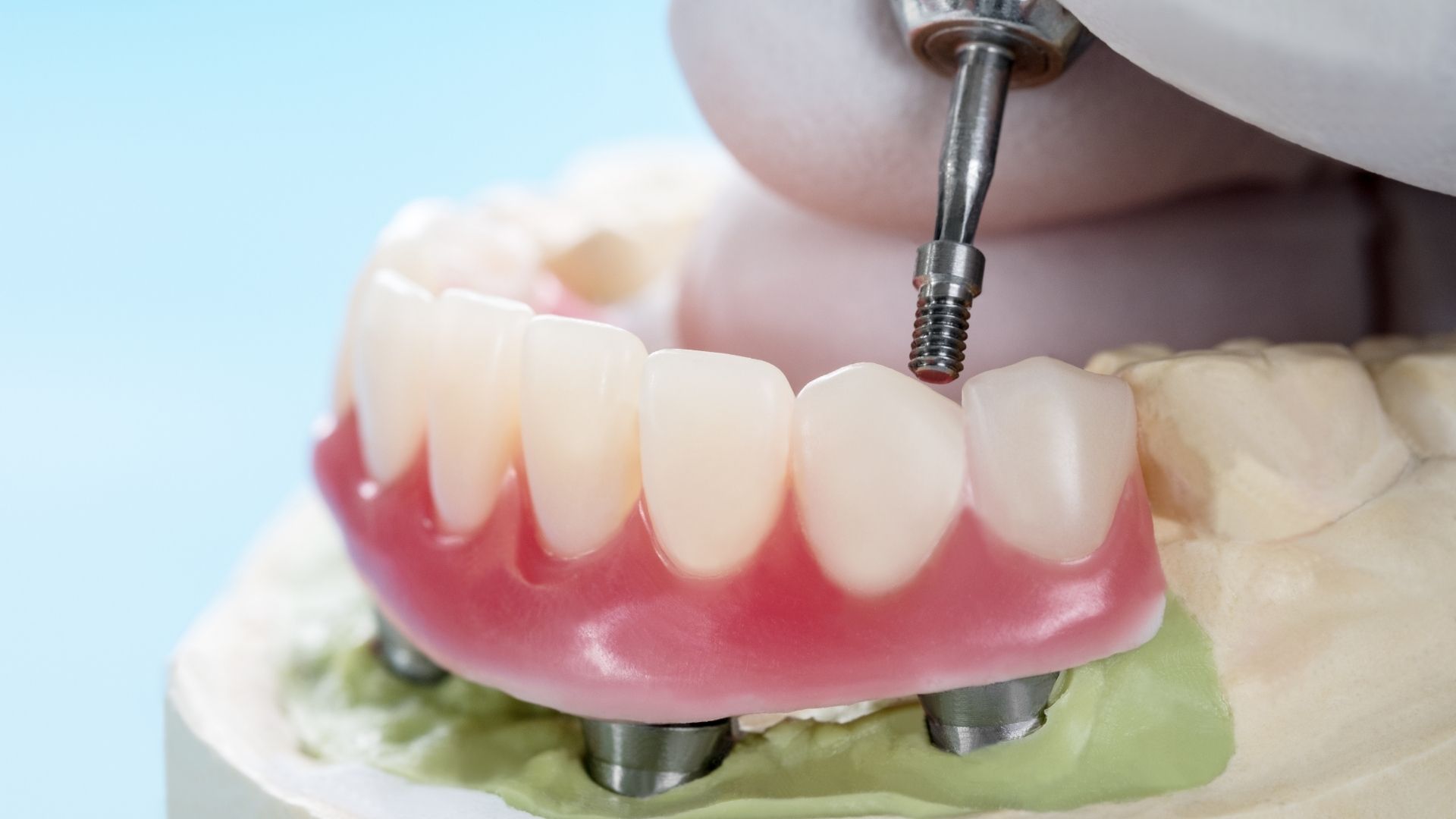 Implant-supported overdentures 
