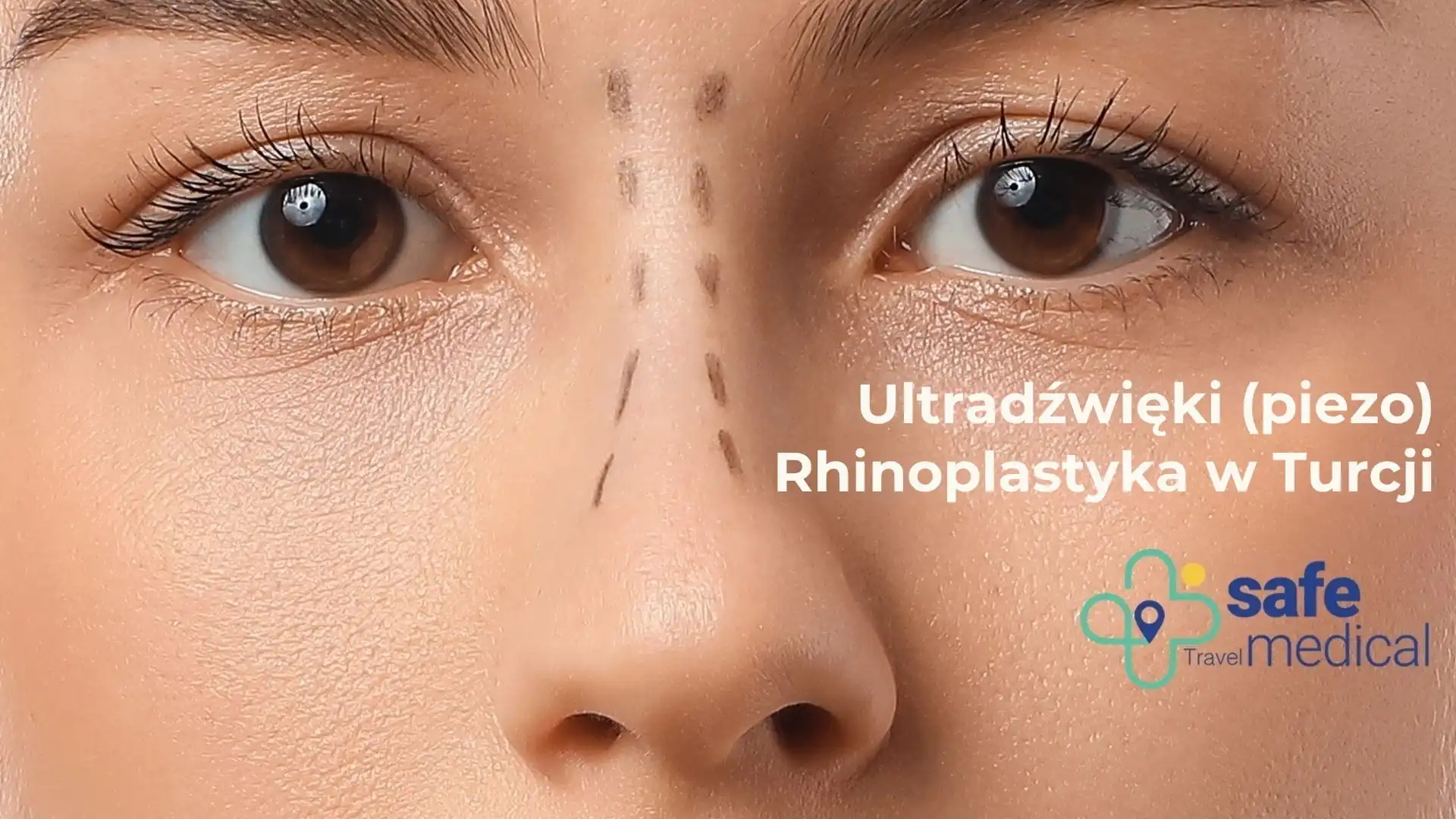 Rynochirurgia ultradźwiękowa (korekta nosa) w Turcji