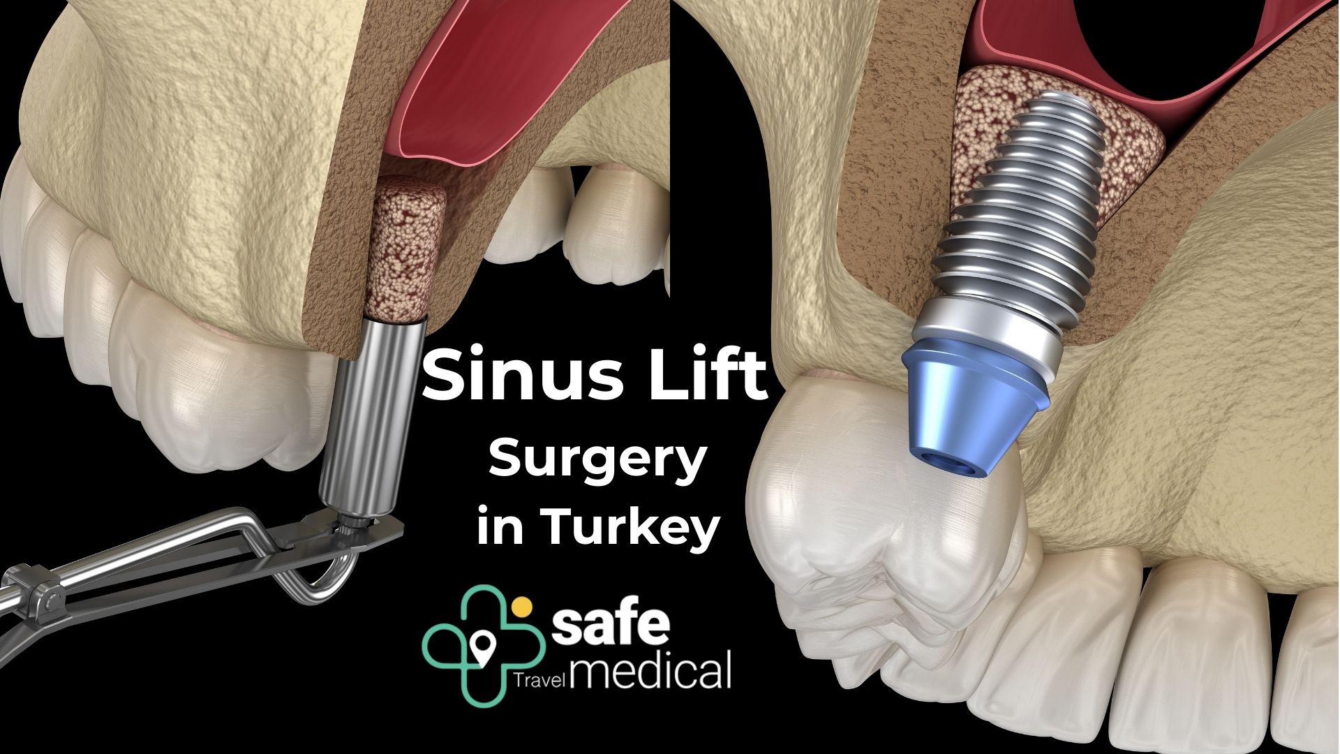 Sinus Lift Surgery in Turkey 