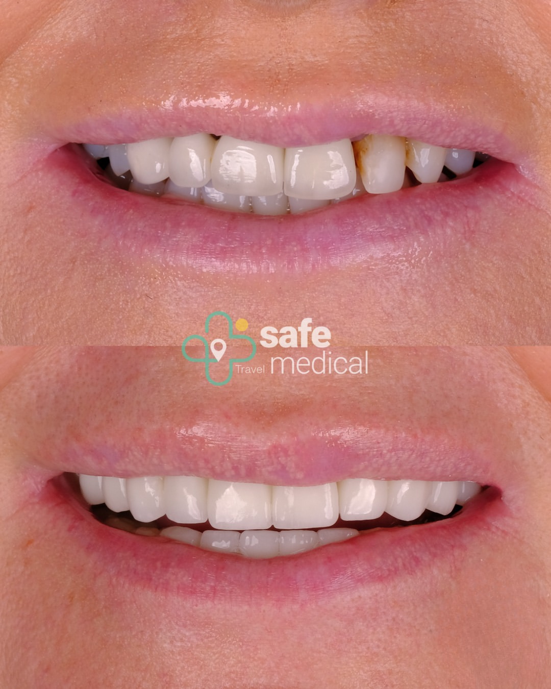 Dental veneer in Turkey