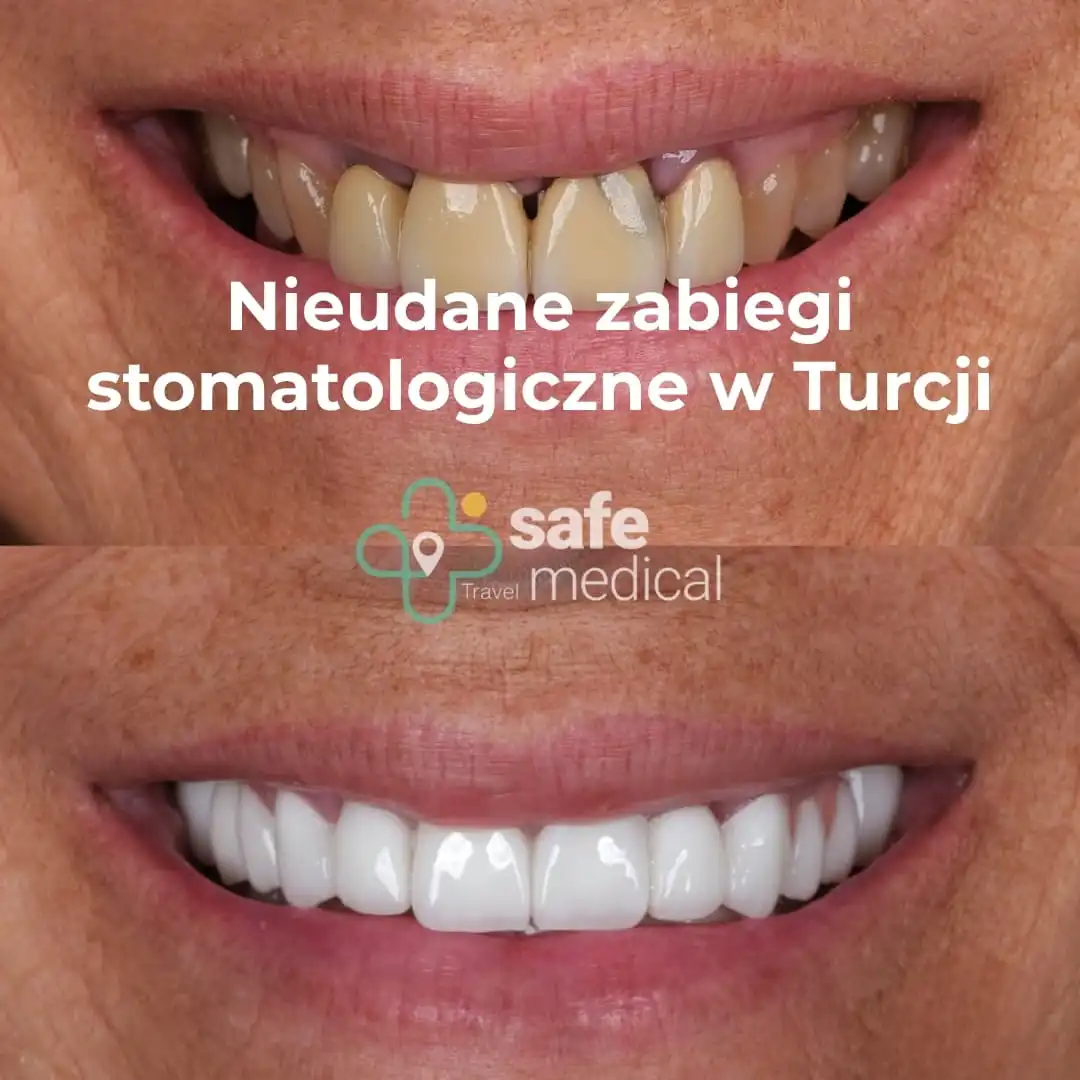 Nieudane zabiegi stomatologiczne w Turcji