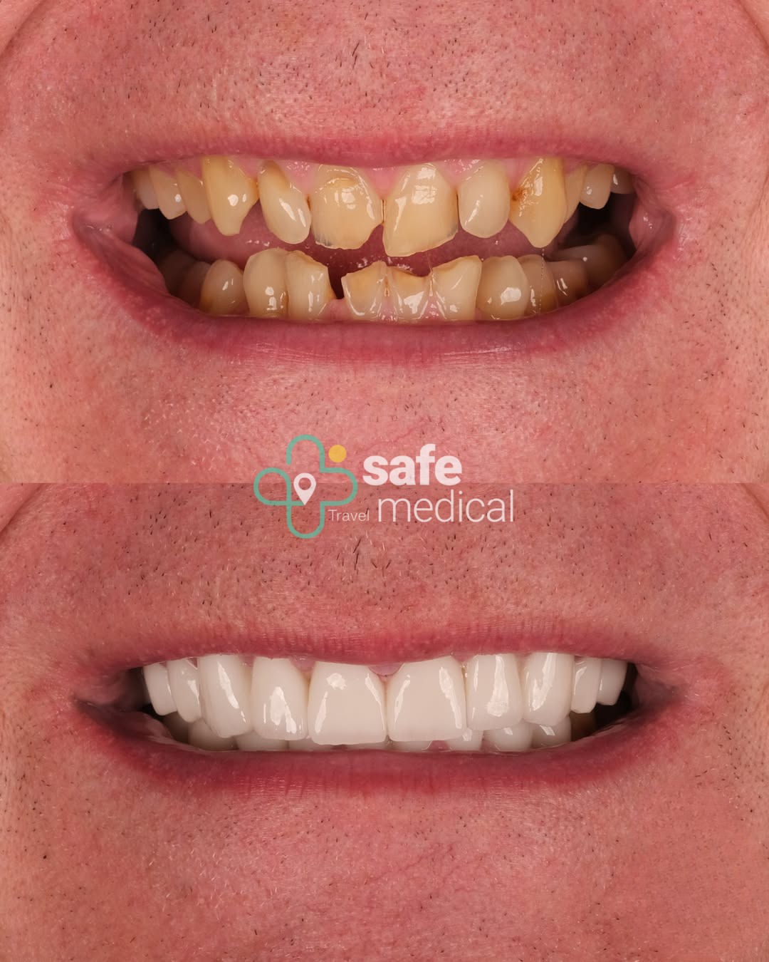 Zirconia crown Turkey