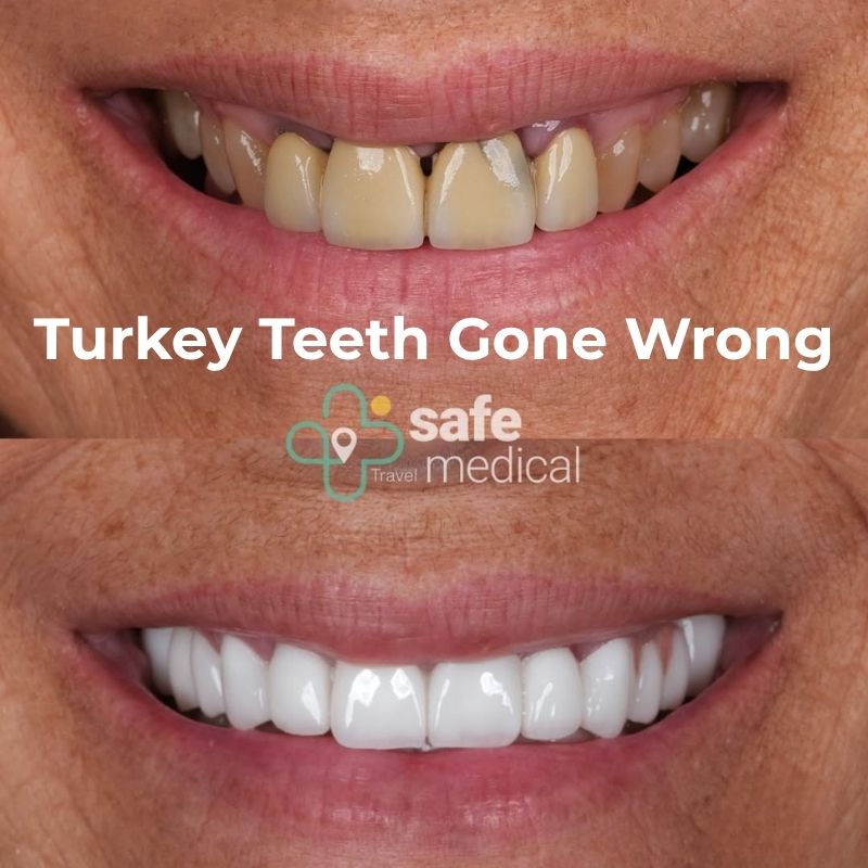 turkey-teeth-gone-wrong