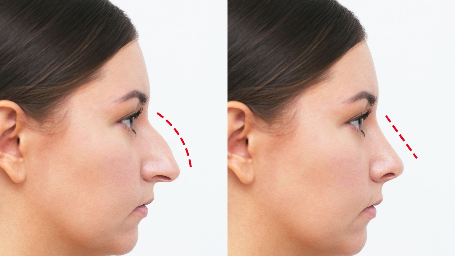 ultrasonic-piezo-rhinoplasty-turkey-3