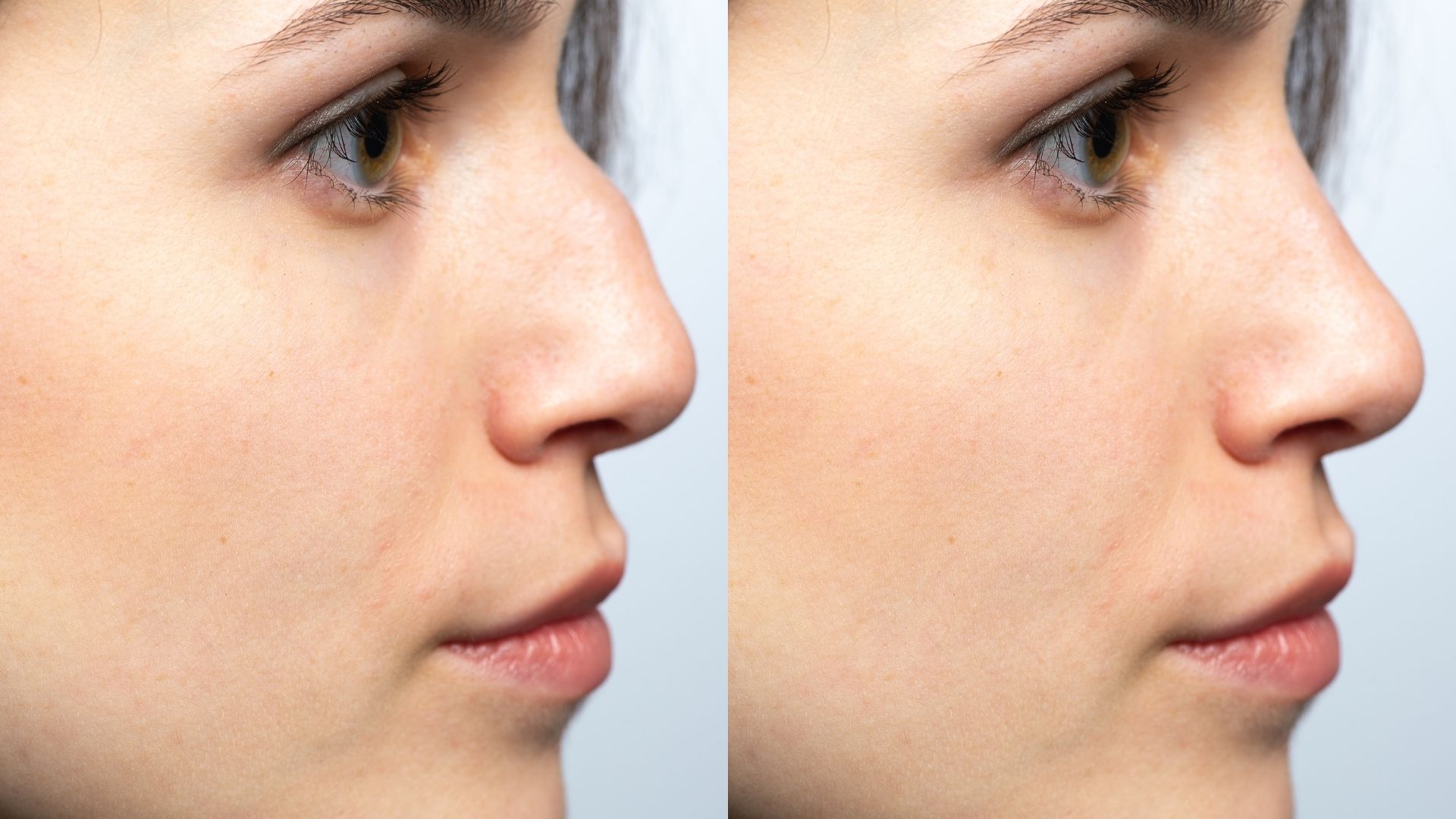 ultrasonic-piezo-rhinoplasty-turkey-4