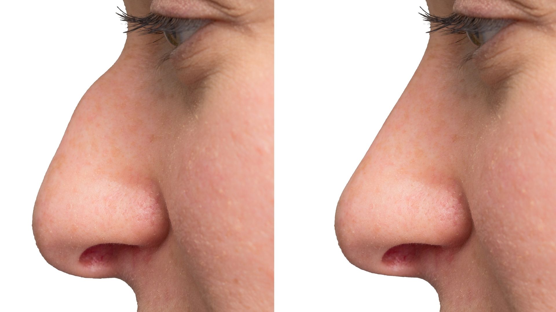 ultrasonic-piezo-rhinoplasty-turkey-5