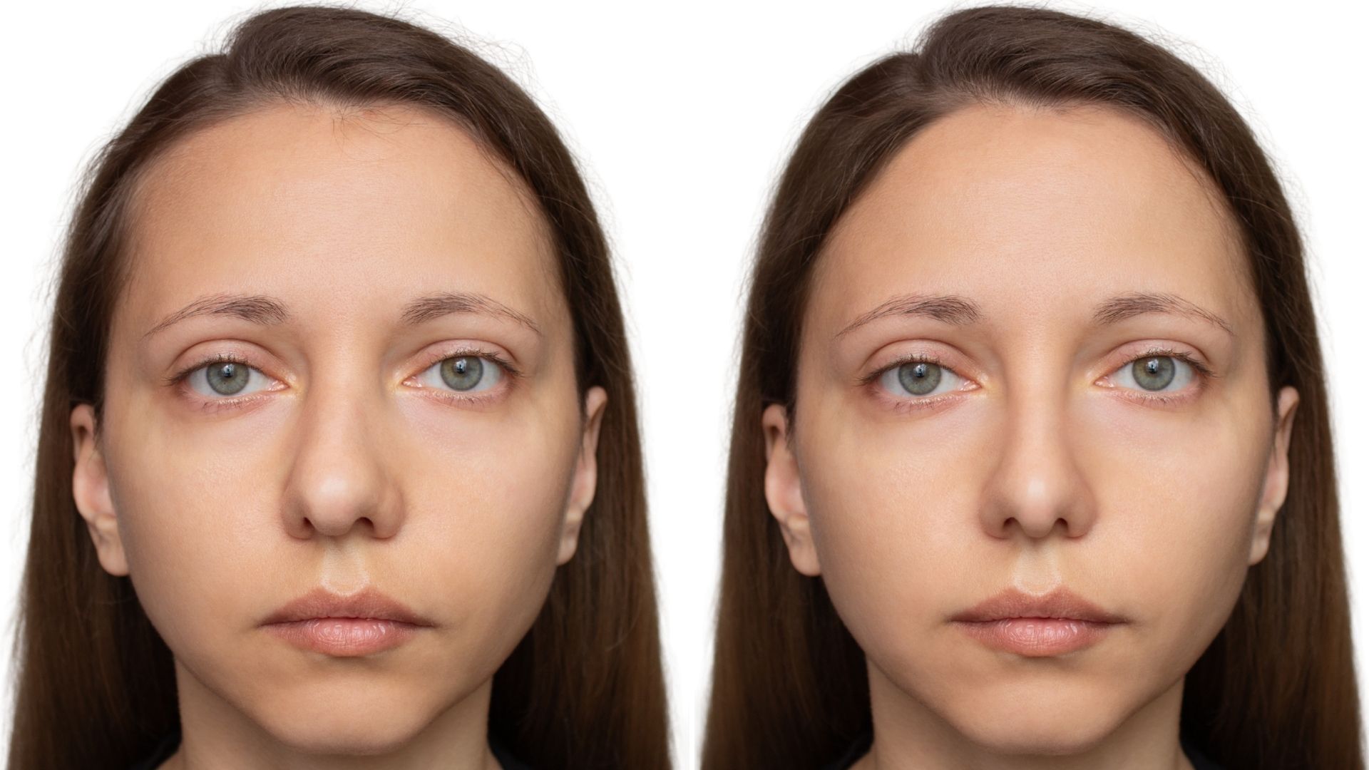 ultrasonic-piezo-rhinoplasty-turkey-6