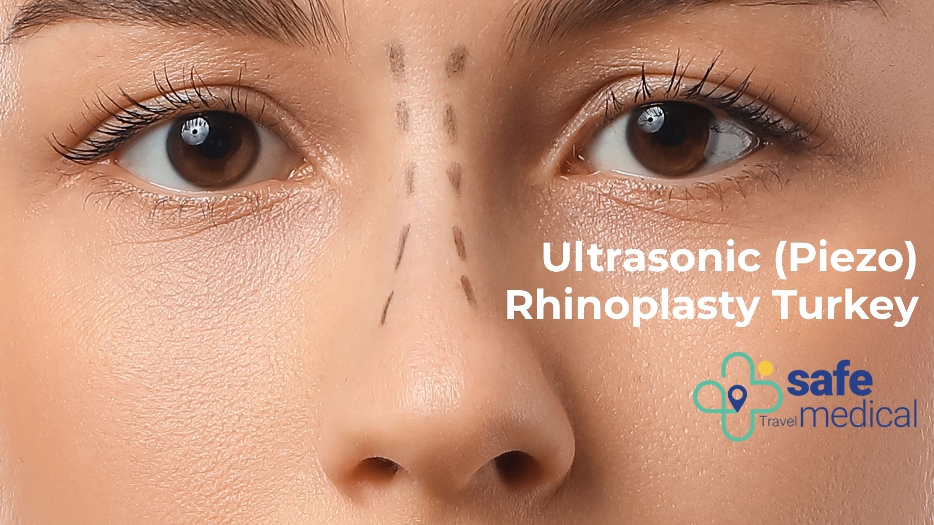 Ultrasonic Rhinoplasty/ Piezo Rhinoplasty in Turkey