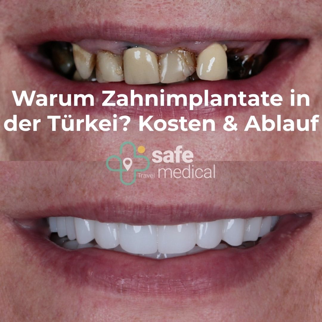 warum-zahnimplantate-in-der-turkei?