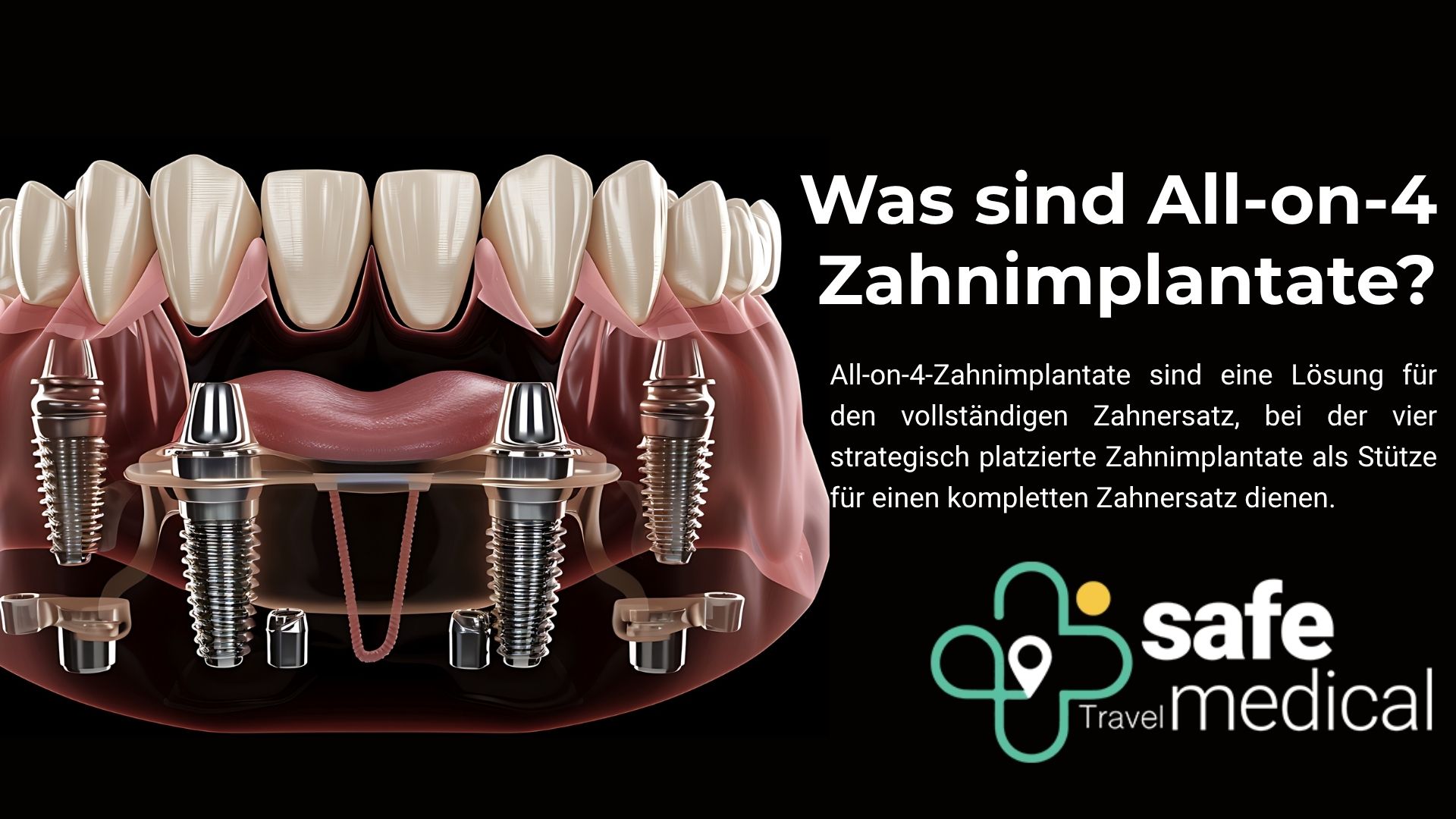 was-sind-all-on-4-zahnimplantate?