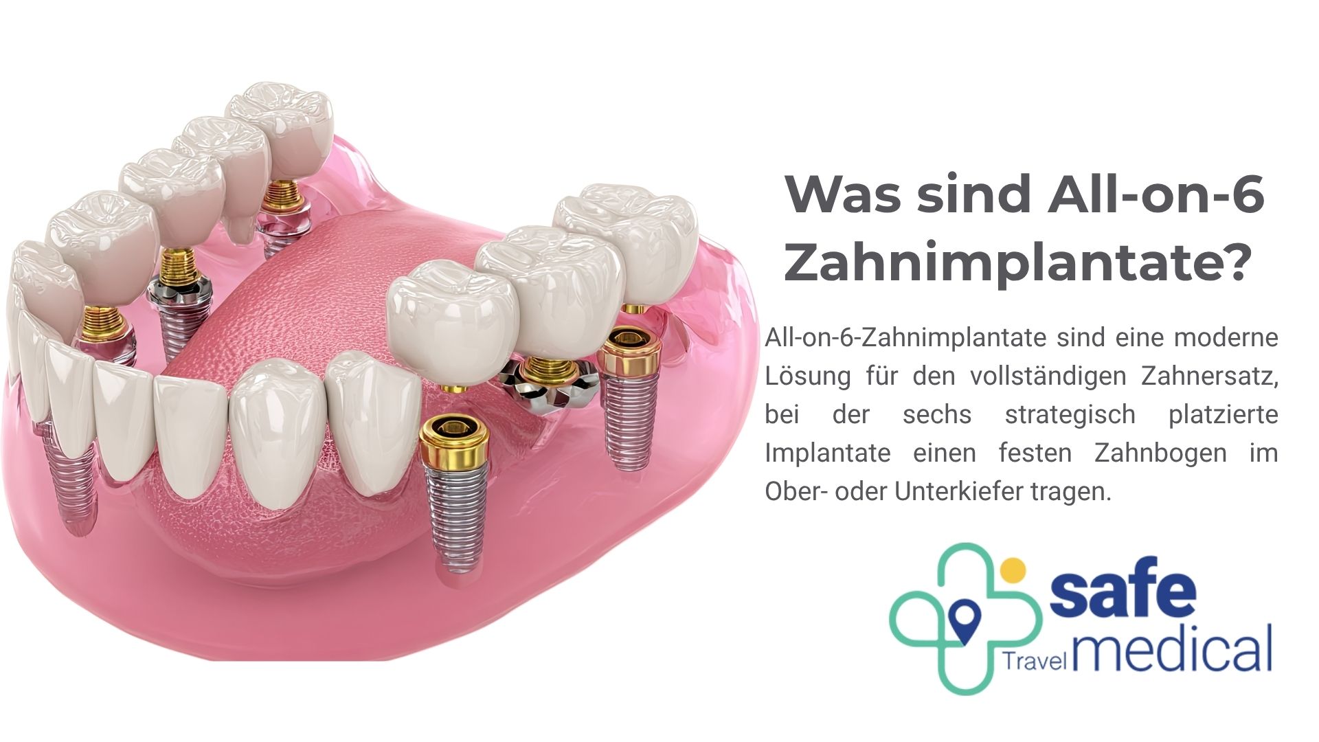 was-sind-all-on-6-zahnimplantate?