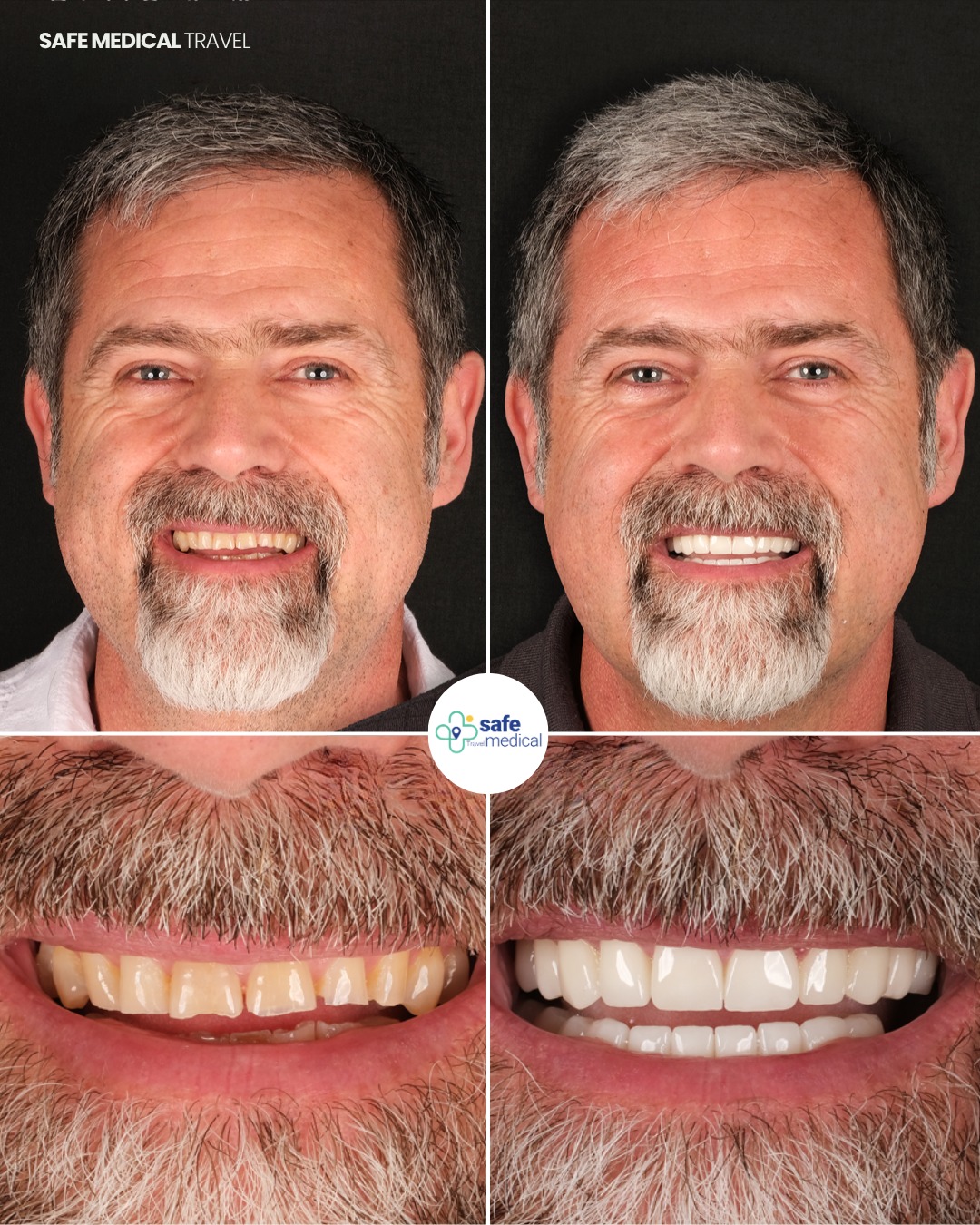 all-on-4 before and after-1