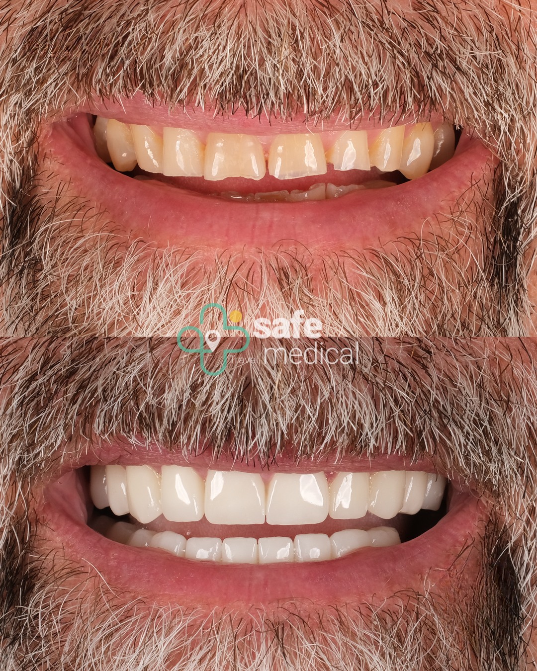 all-on-4 before and after-2