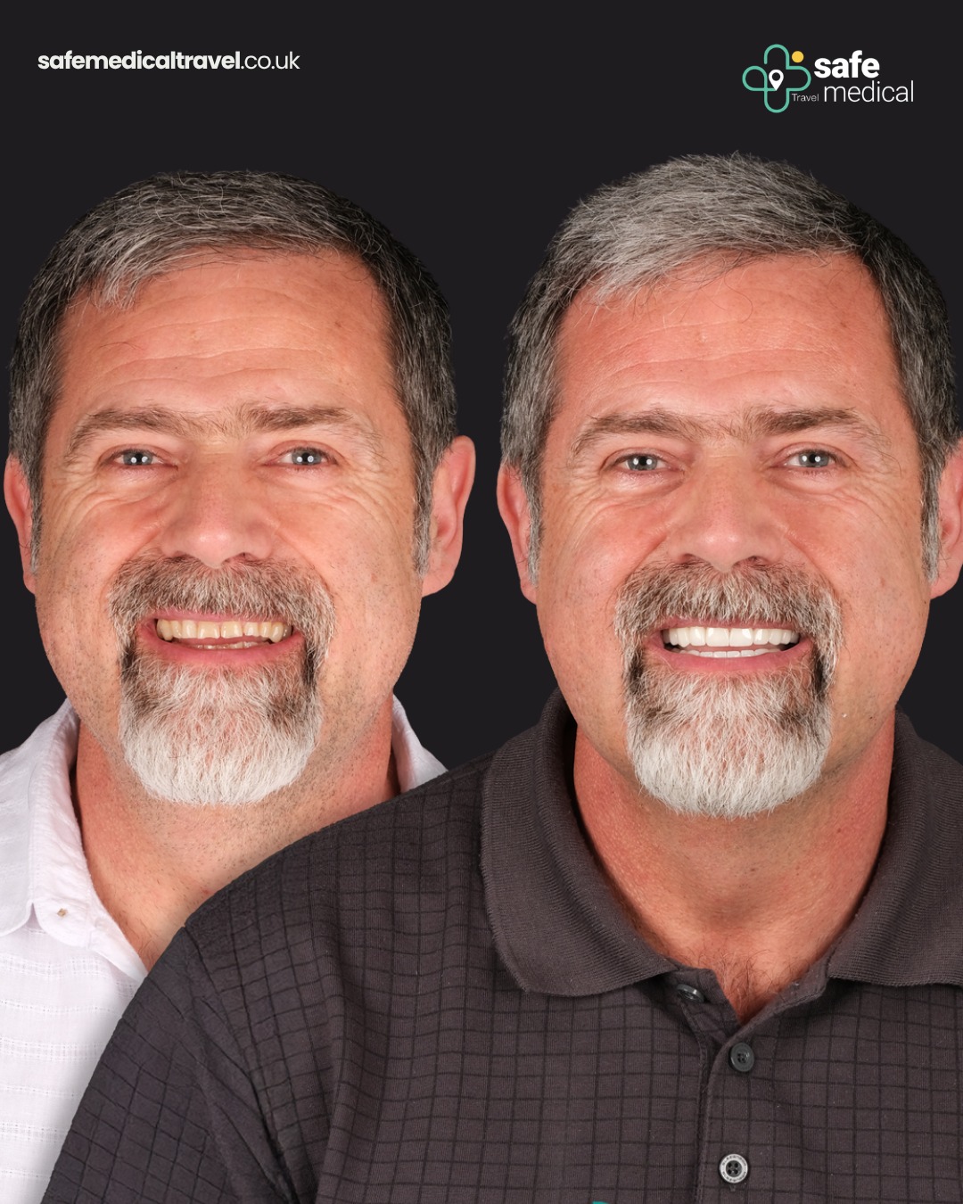 all-on-4 before and after-3