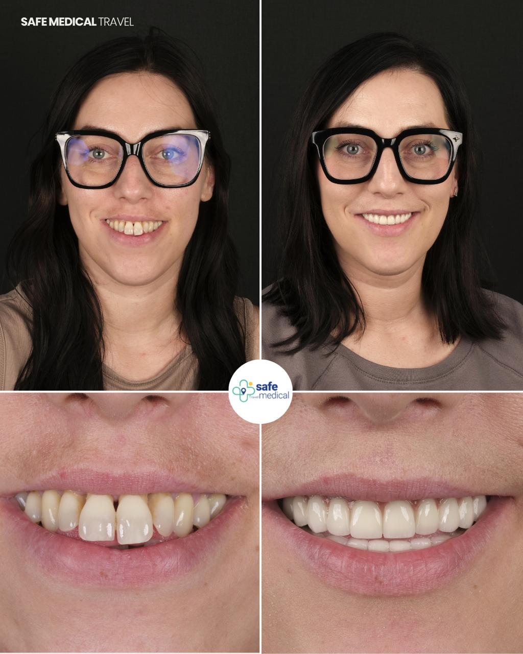 all-on-4 before and after-4