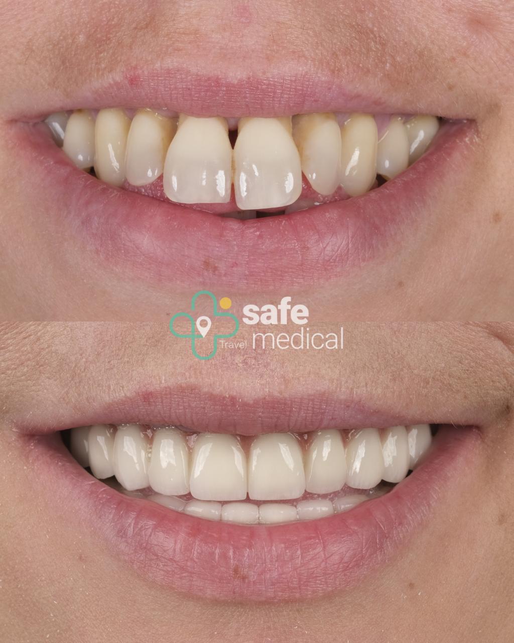 all-on-4 before and after-5
