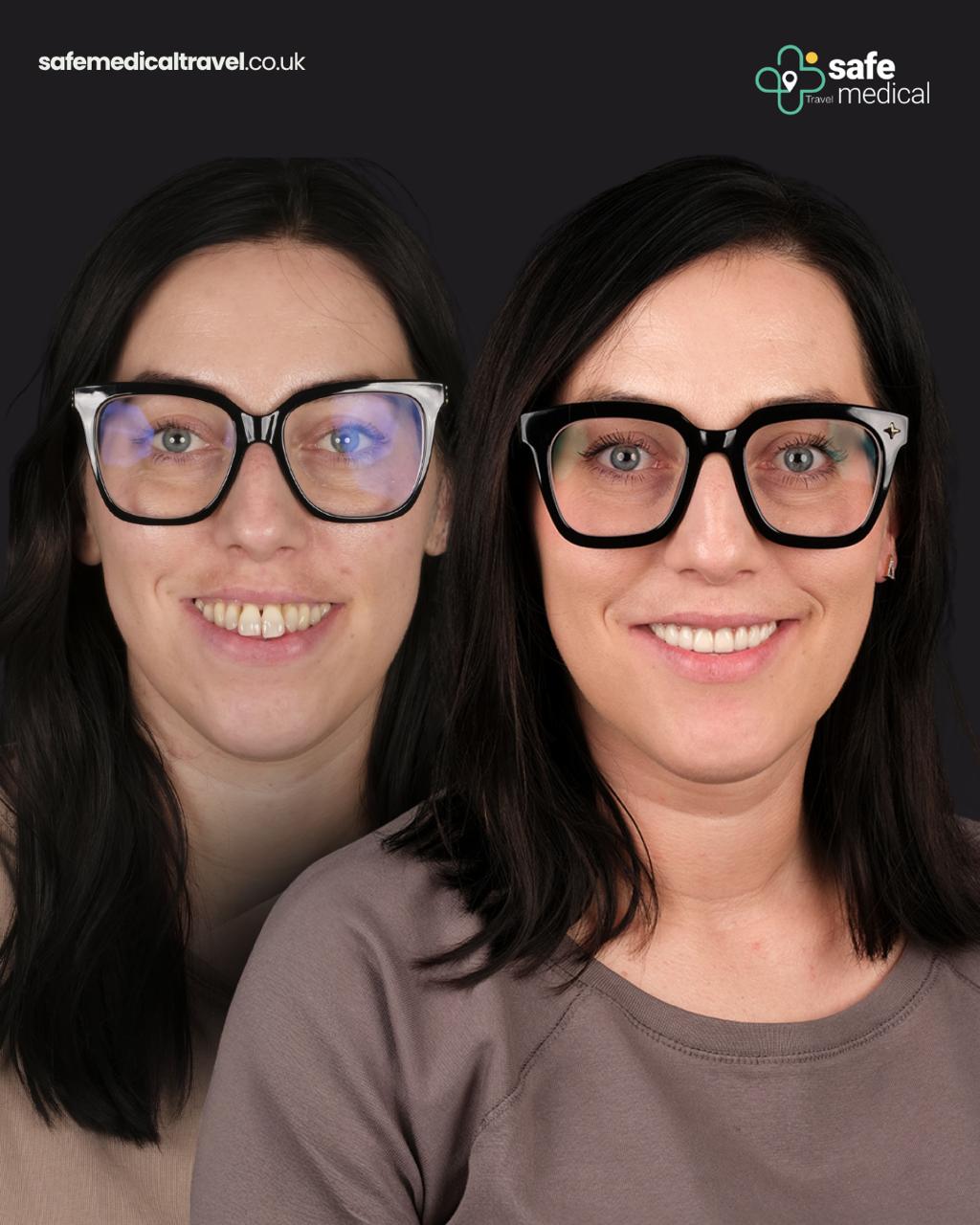 all-on-4 before and after-6