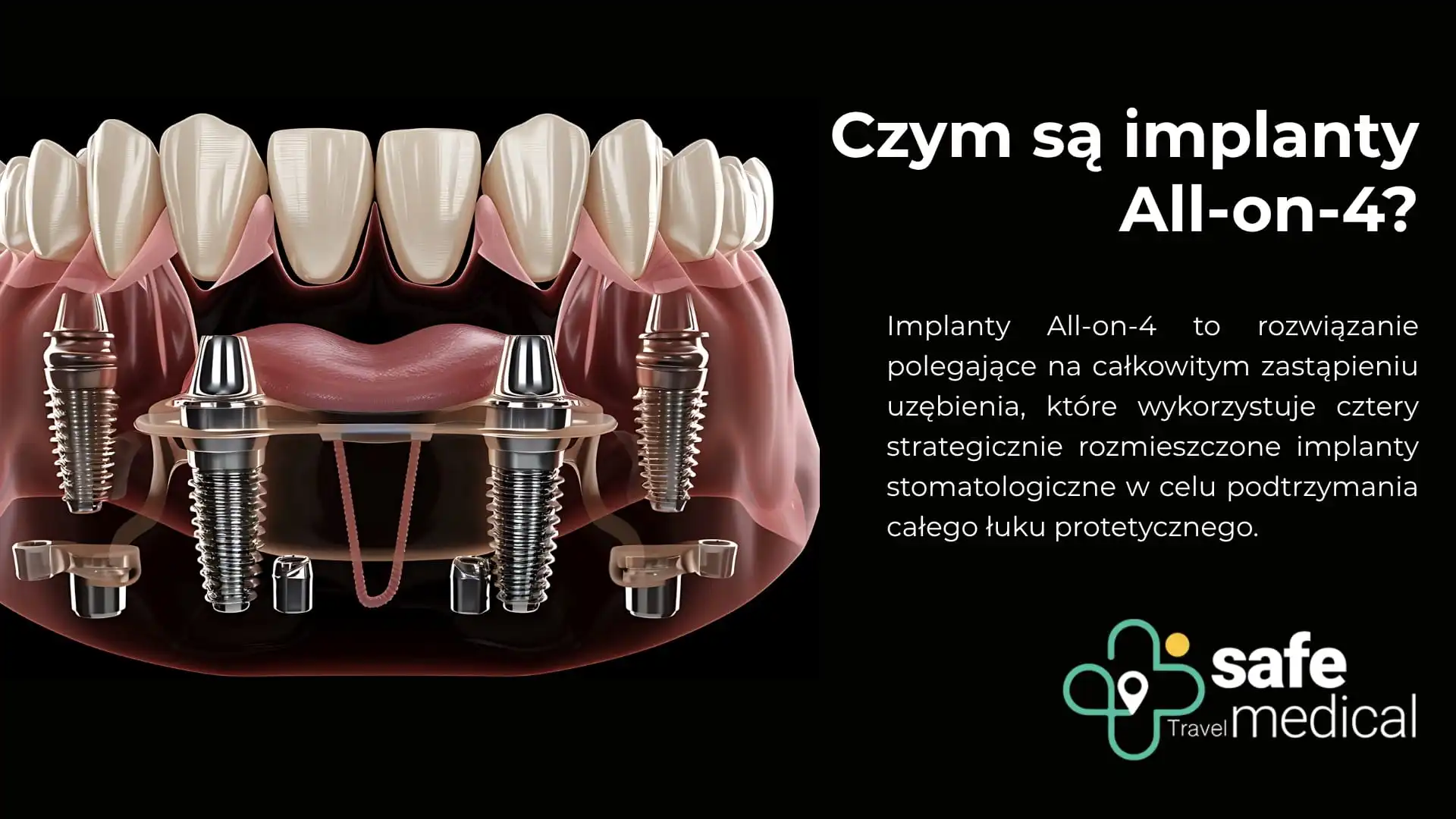 Czym są implanty All-on-4 (cztery)? Koszt i zalety w Turcji