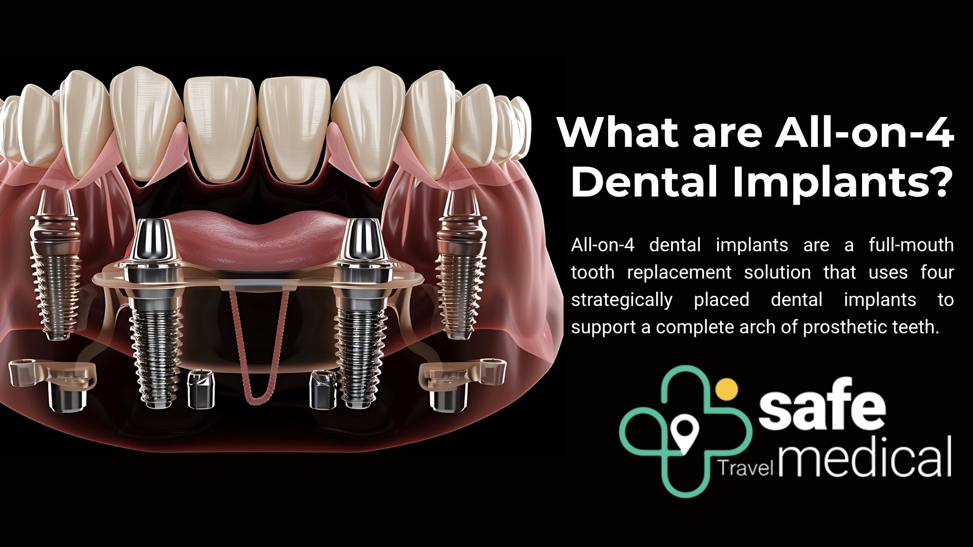what-are-all-on-4-implants-in-turkey