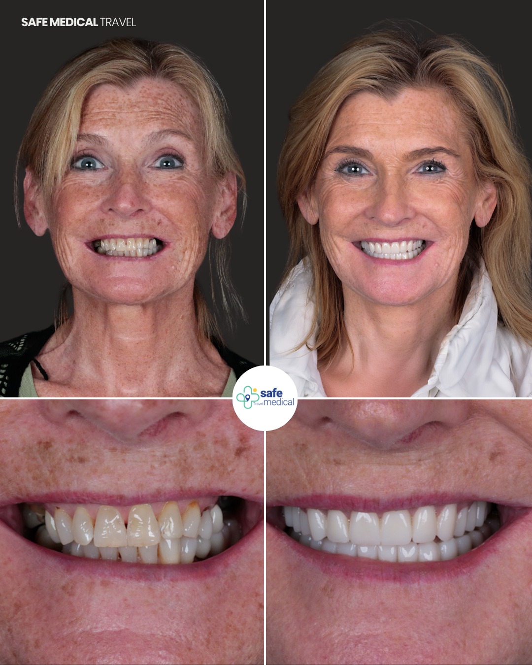 all-on-6 before and after-1