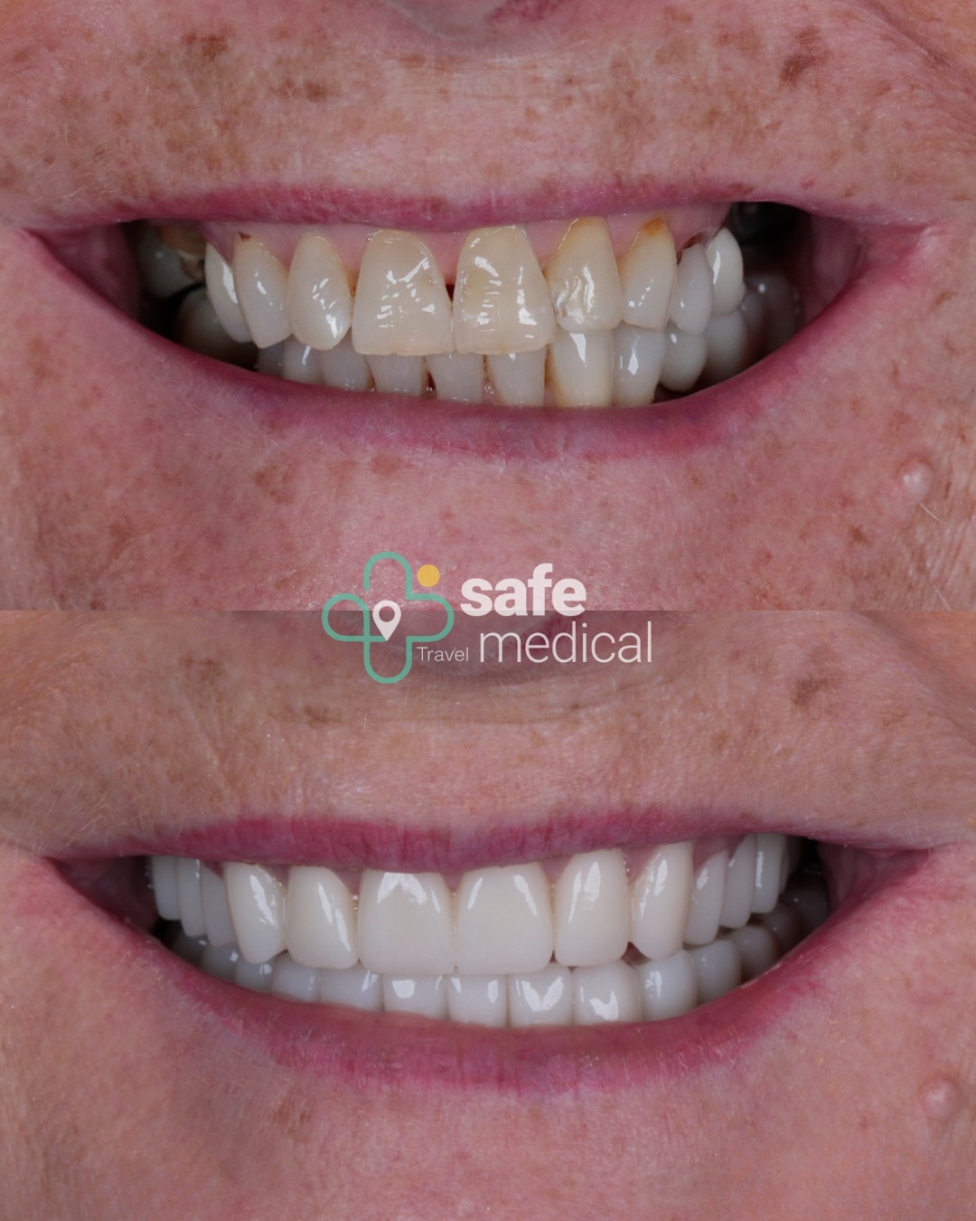 all-on-6 before and after-2