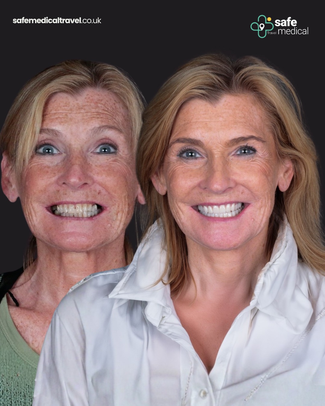 all-on-6 before and after-3