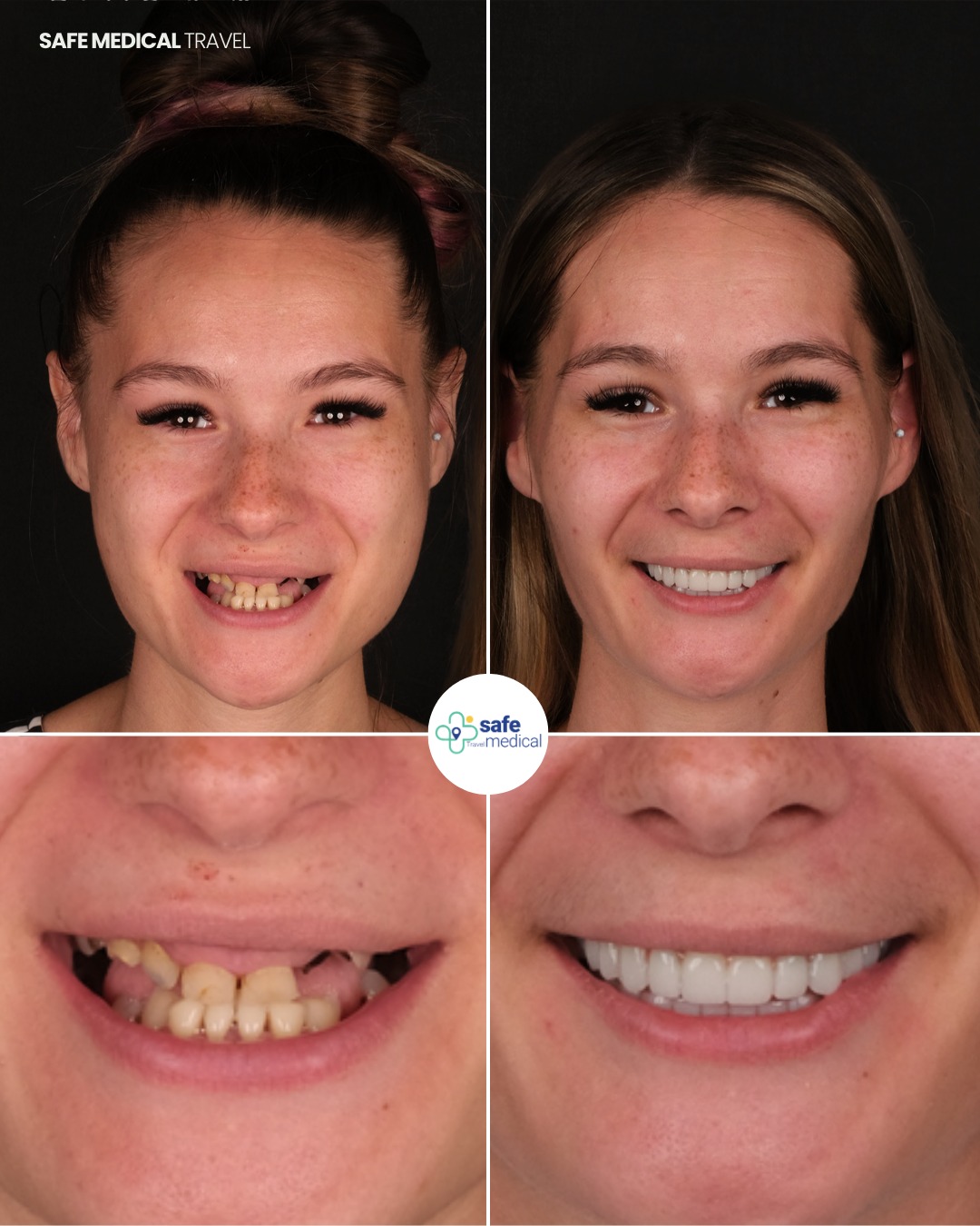 all-on-6 before and after-4