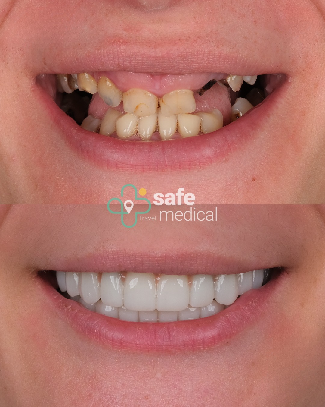 all-on-6 before and after-5