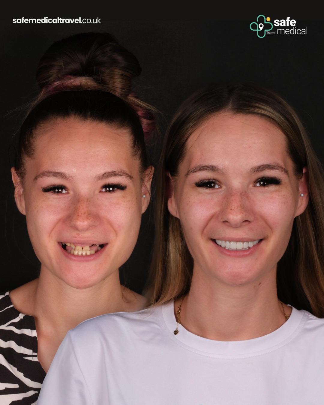 all-on-6 before and after-6