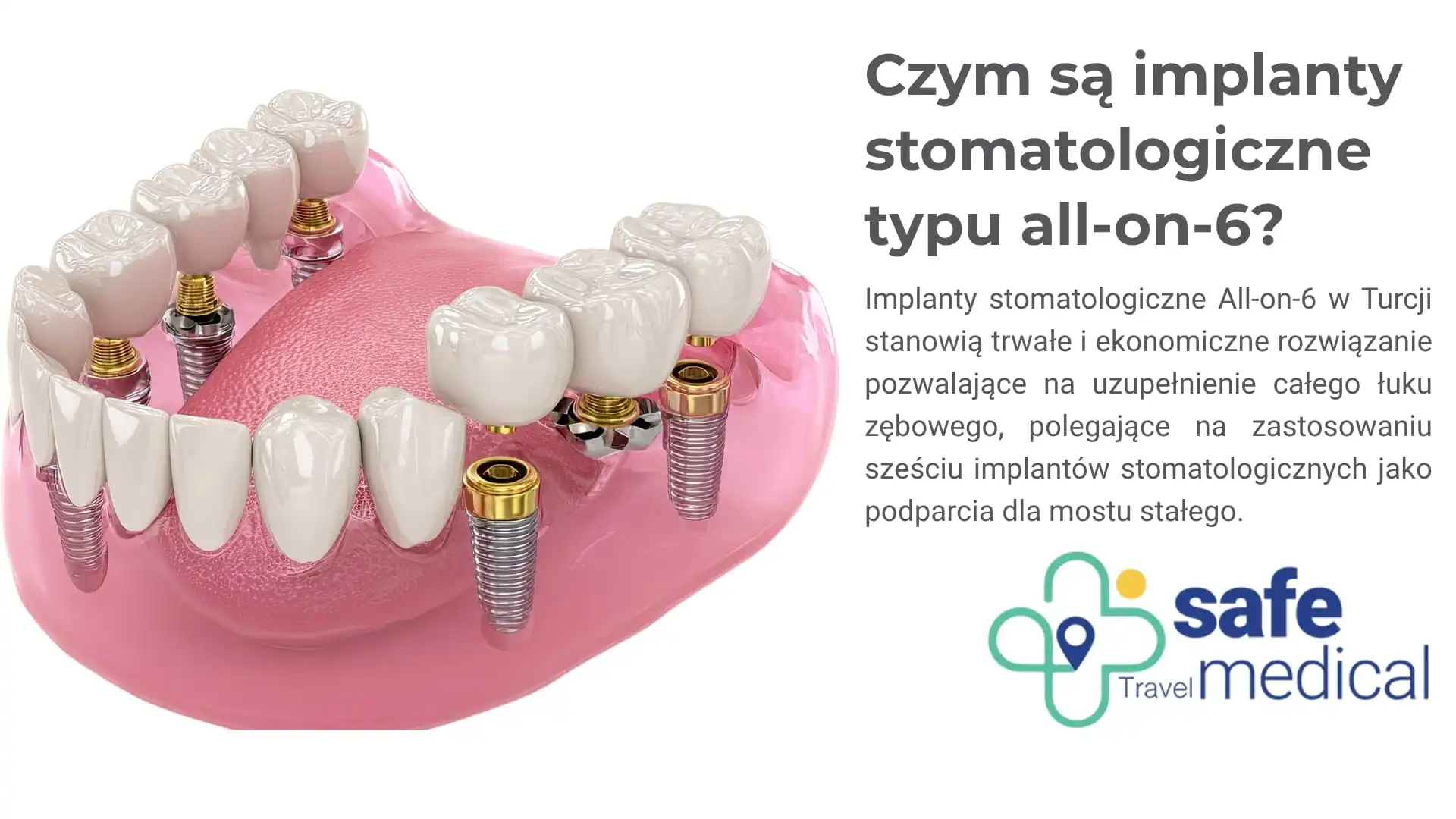 Czym są implanty zębowe All-on-6?