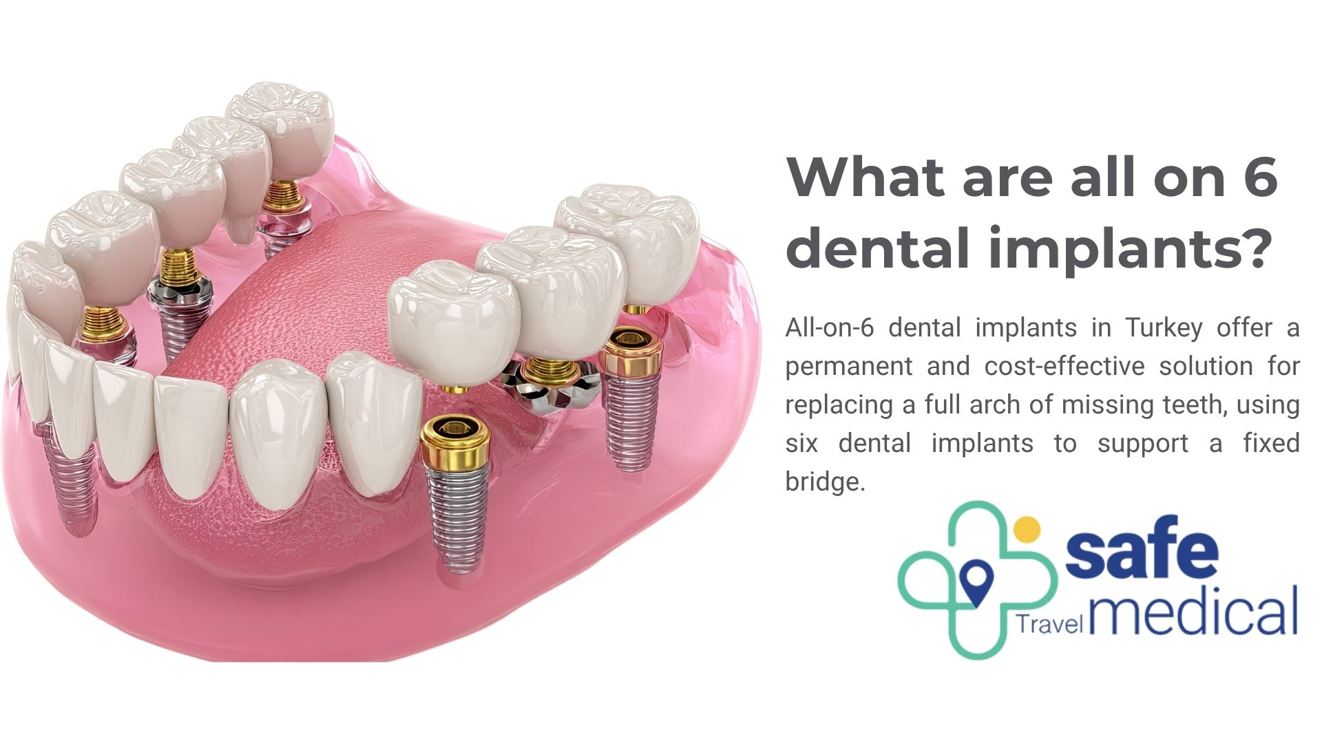 What are all on 6 dental implants? 