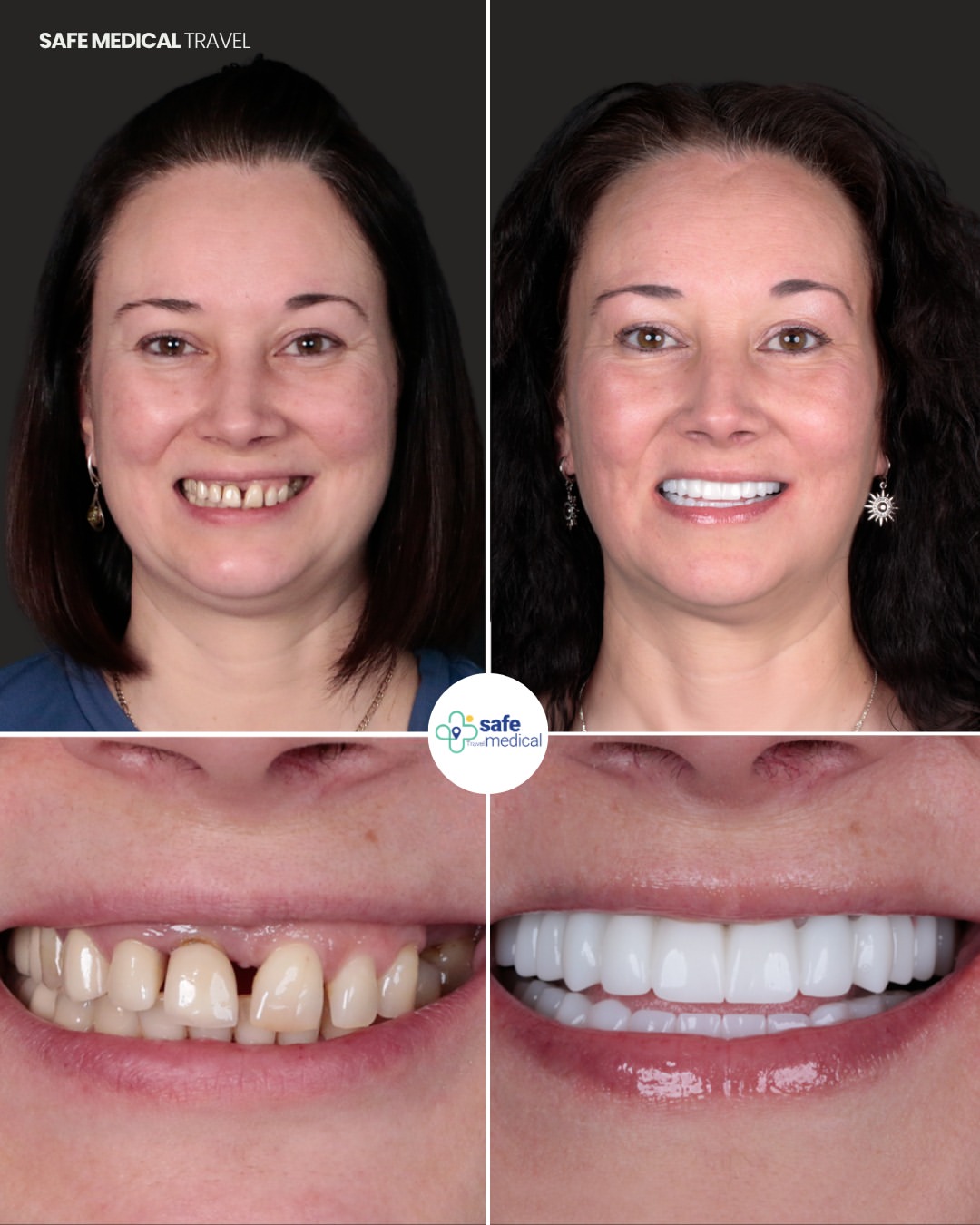 what-is-a-smile-makeover-in-turkey-1 before and after-10