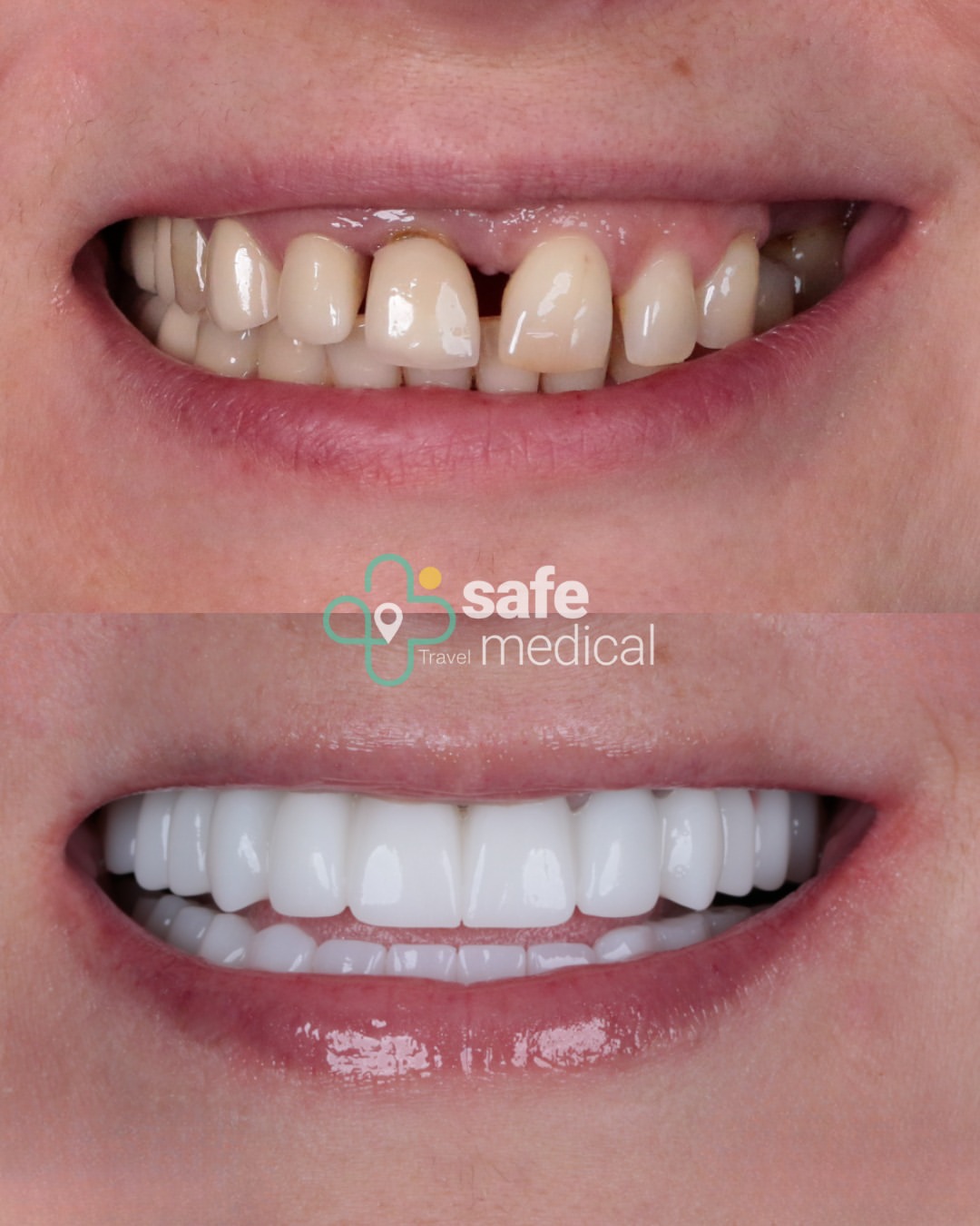 what-is-a-smile-makeover-in-turkey-1 before and after-11