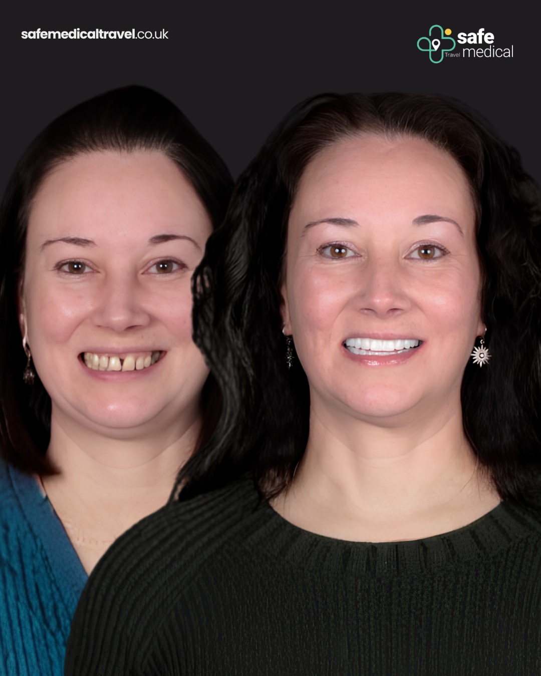 what-is-a-smile-makeover-in-turkey-1 before and after-12