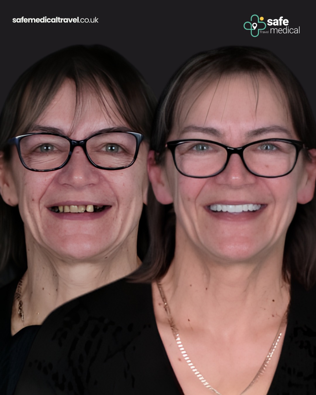 dental-implant-in-turkey before and after-1