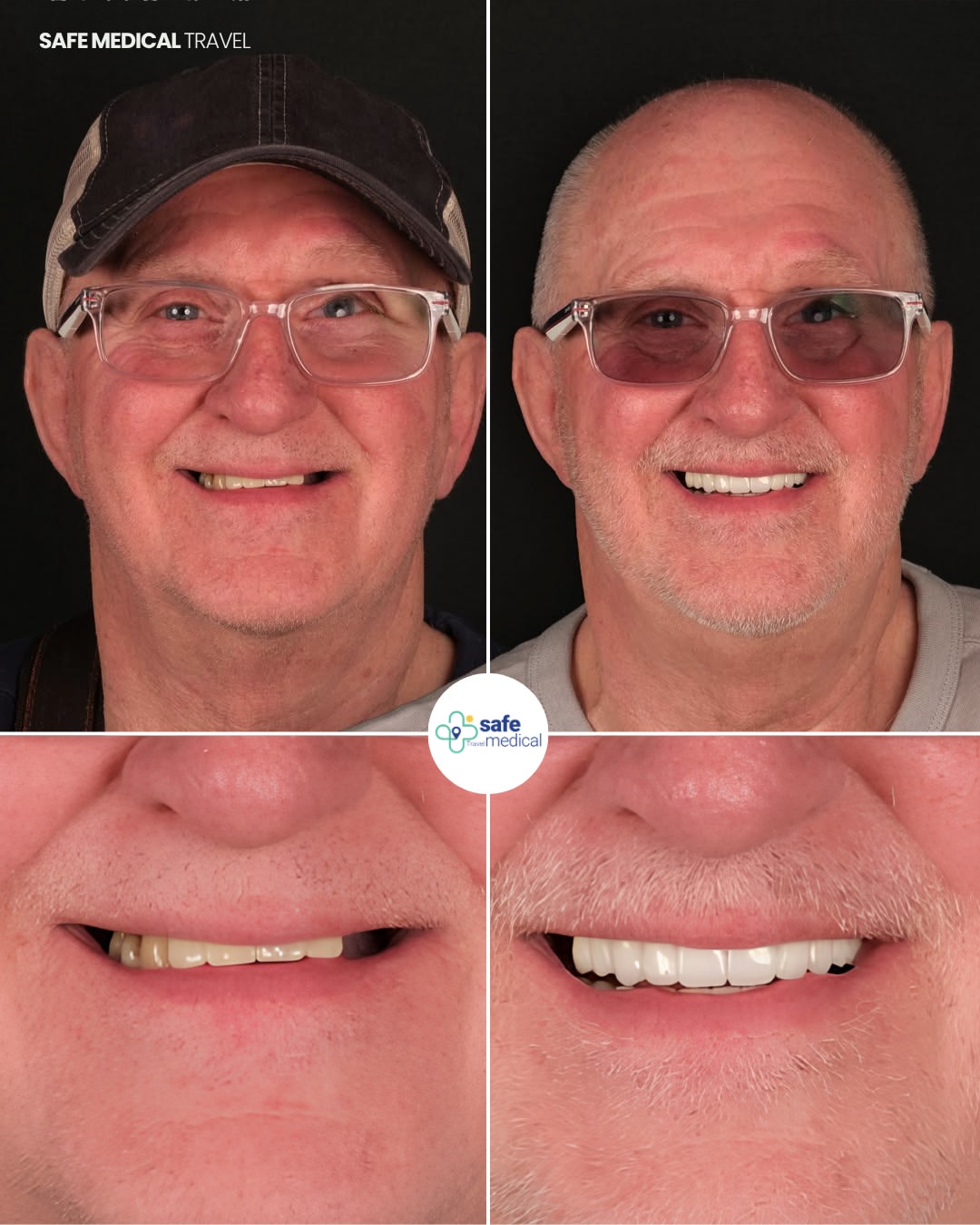 dental-implant-in-turkey before and after-11