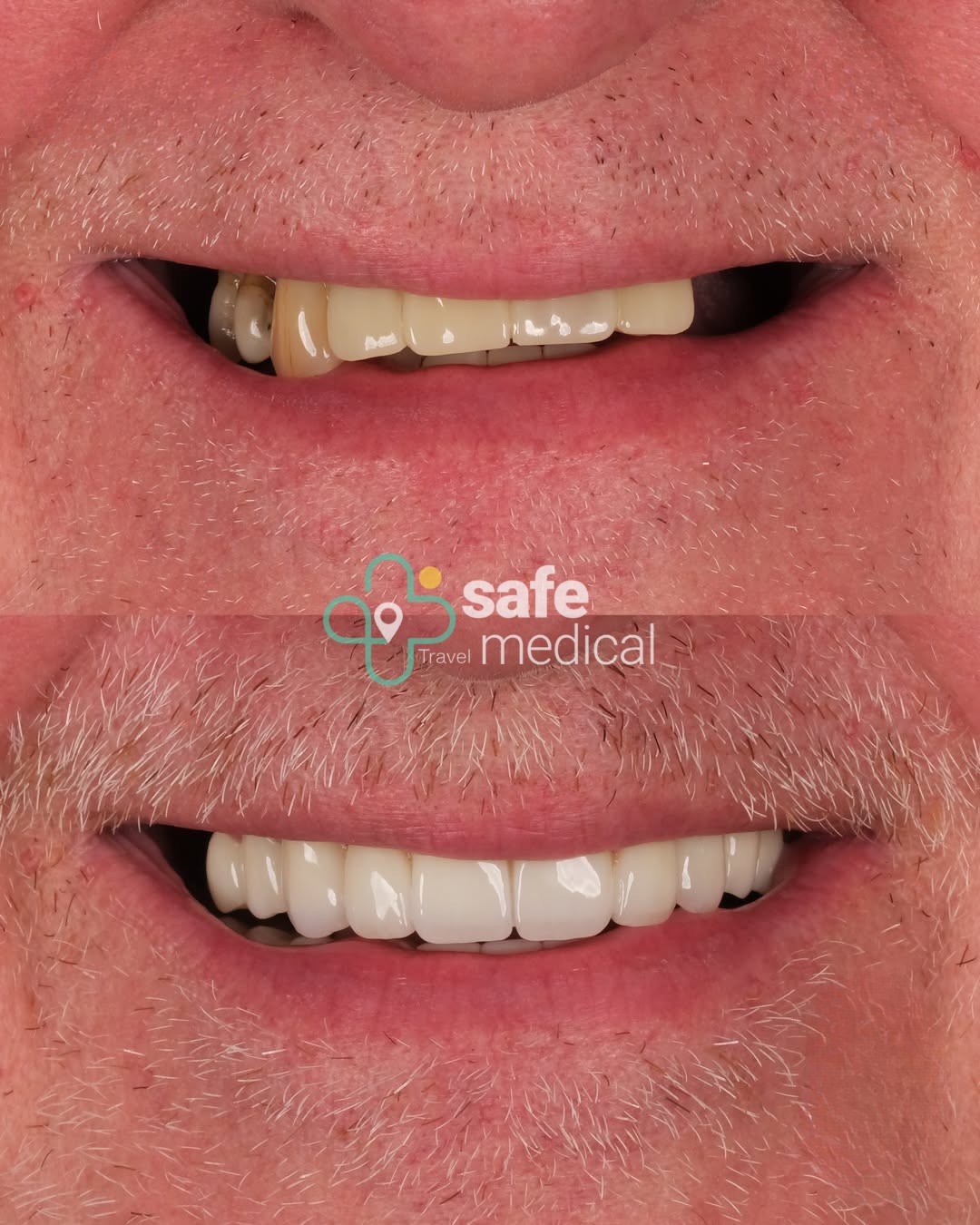 dental-implant-in-turkey before and after-12