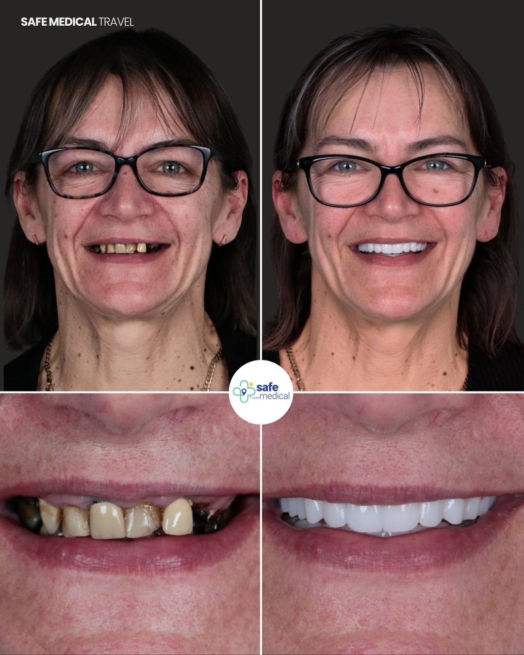 dental-implant-in-turkey before and after-2