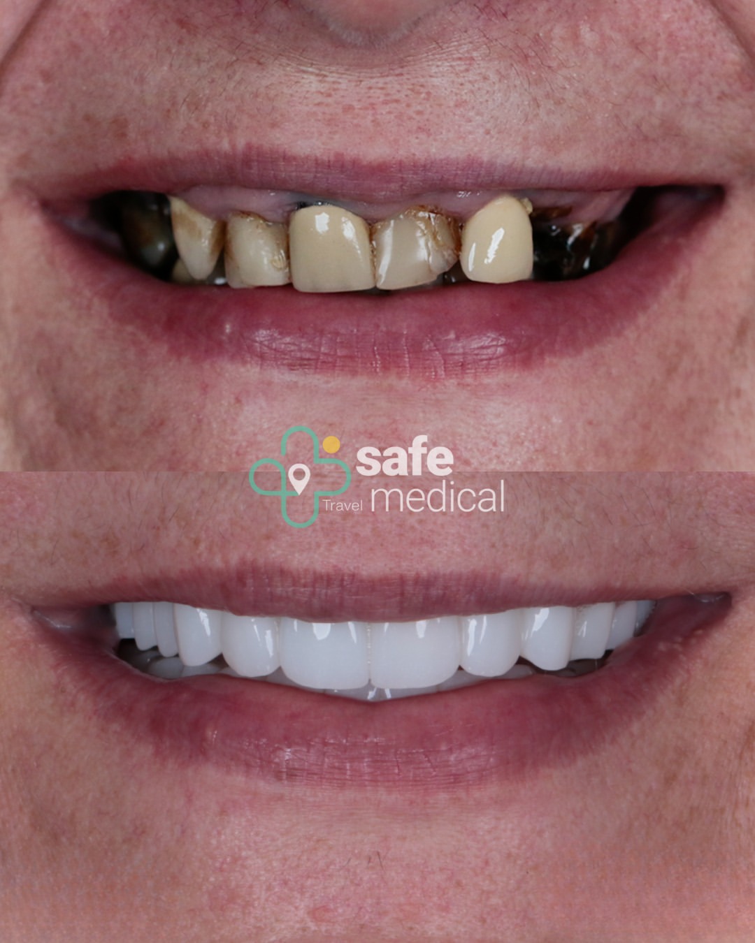 dental-implant-in-turkey before and after-3