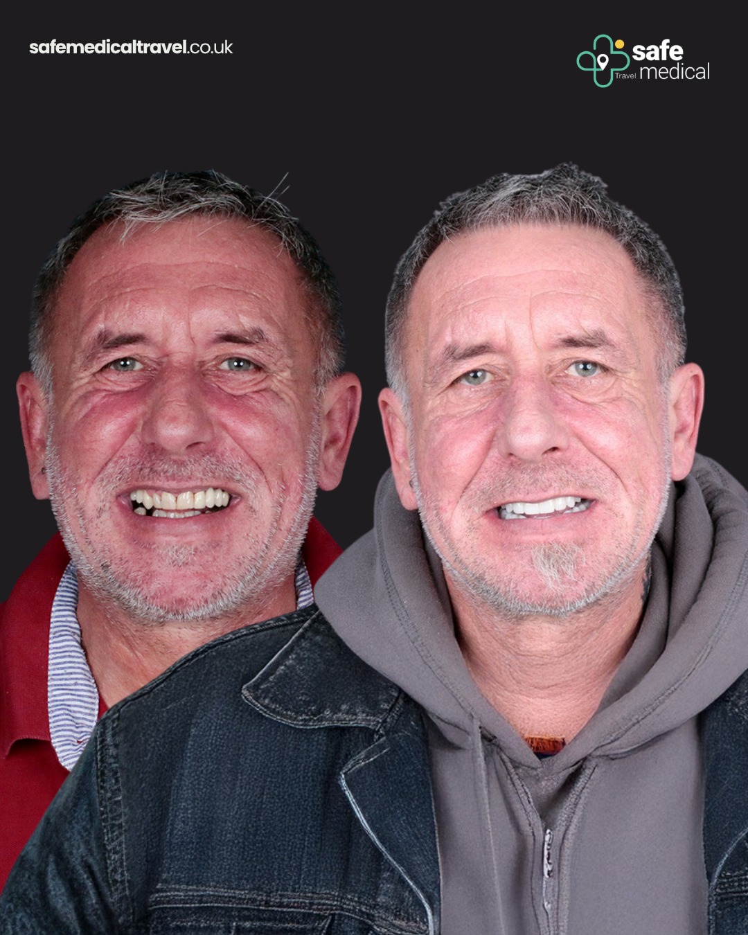 dental-implant-in-turkey before and after-4