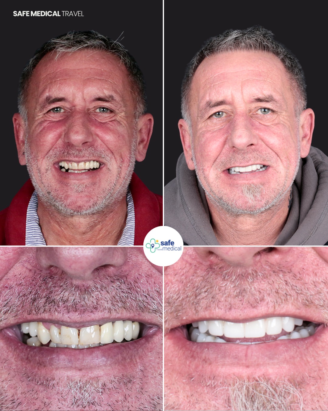 dental-implant-in-turkey before and after-5