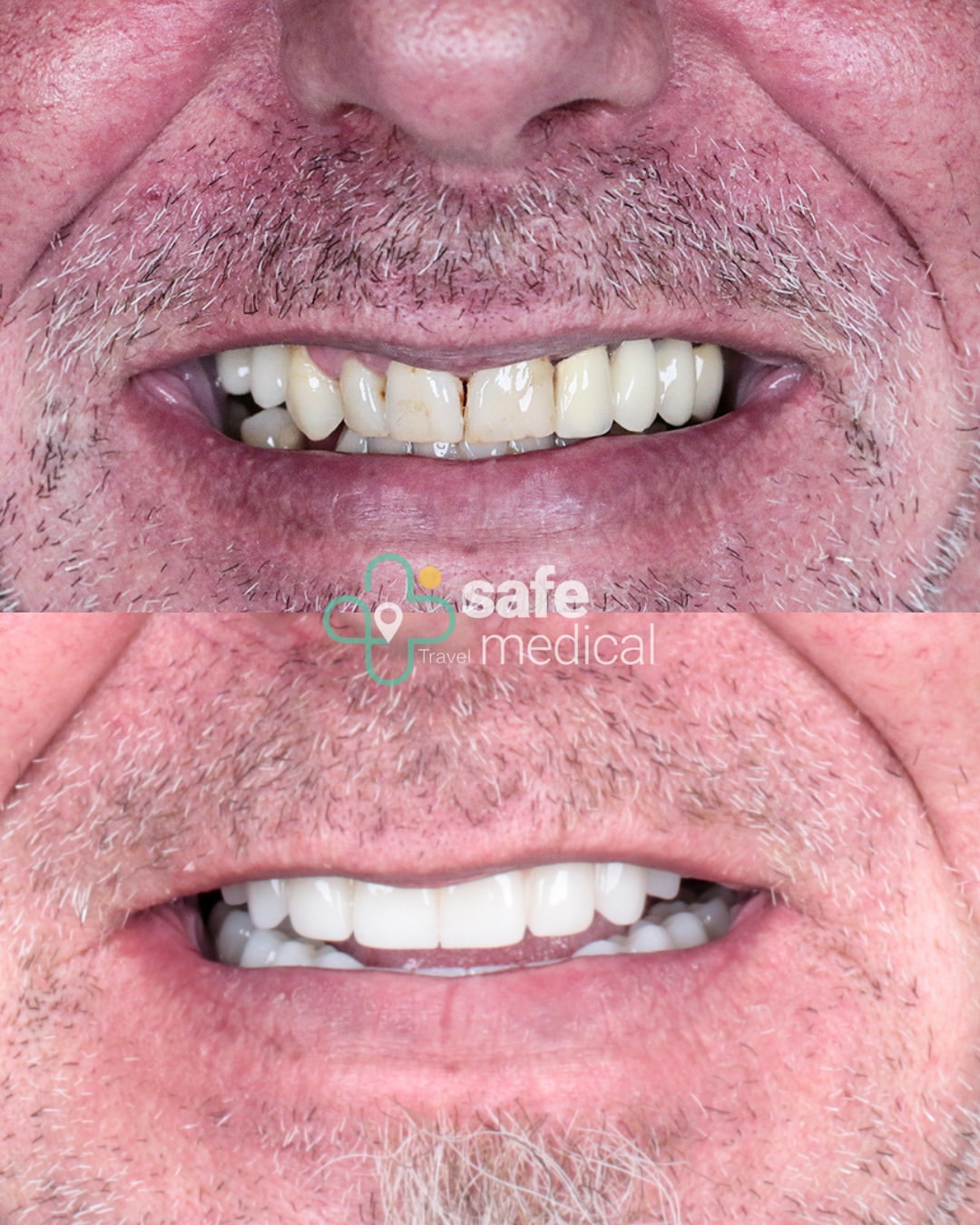 dental-implant-in-turkey before and after-6