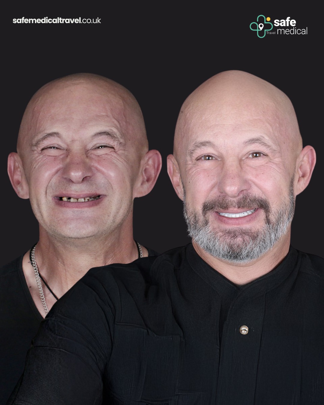 dental-implant-in-turkey before and after-7