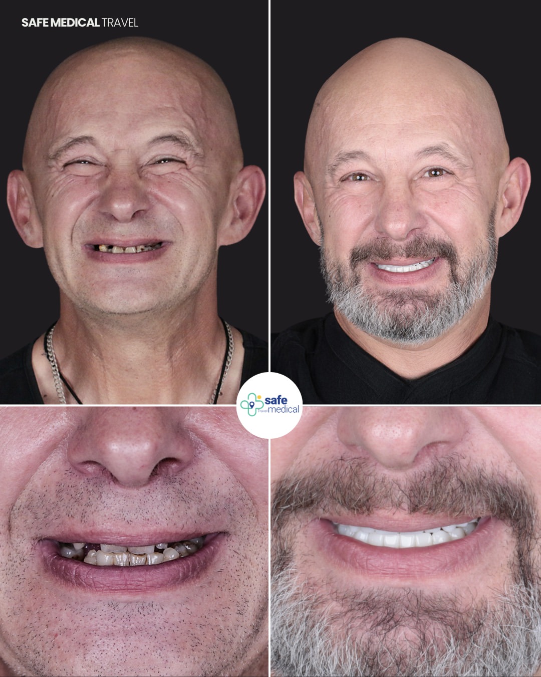 dental-implant-in-turkey before and after-8
